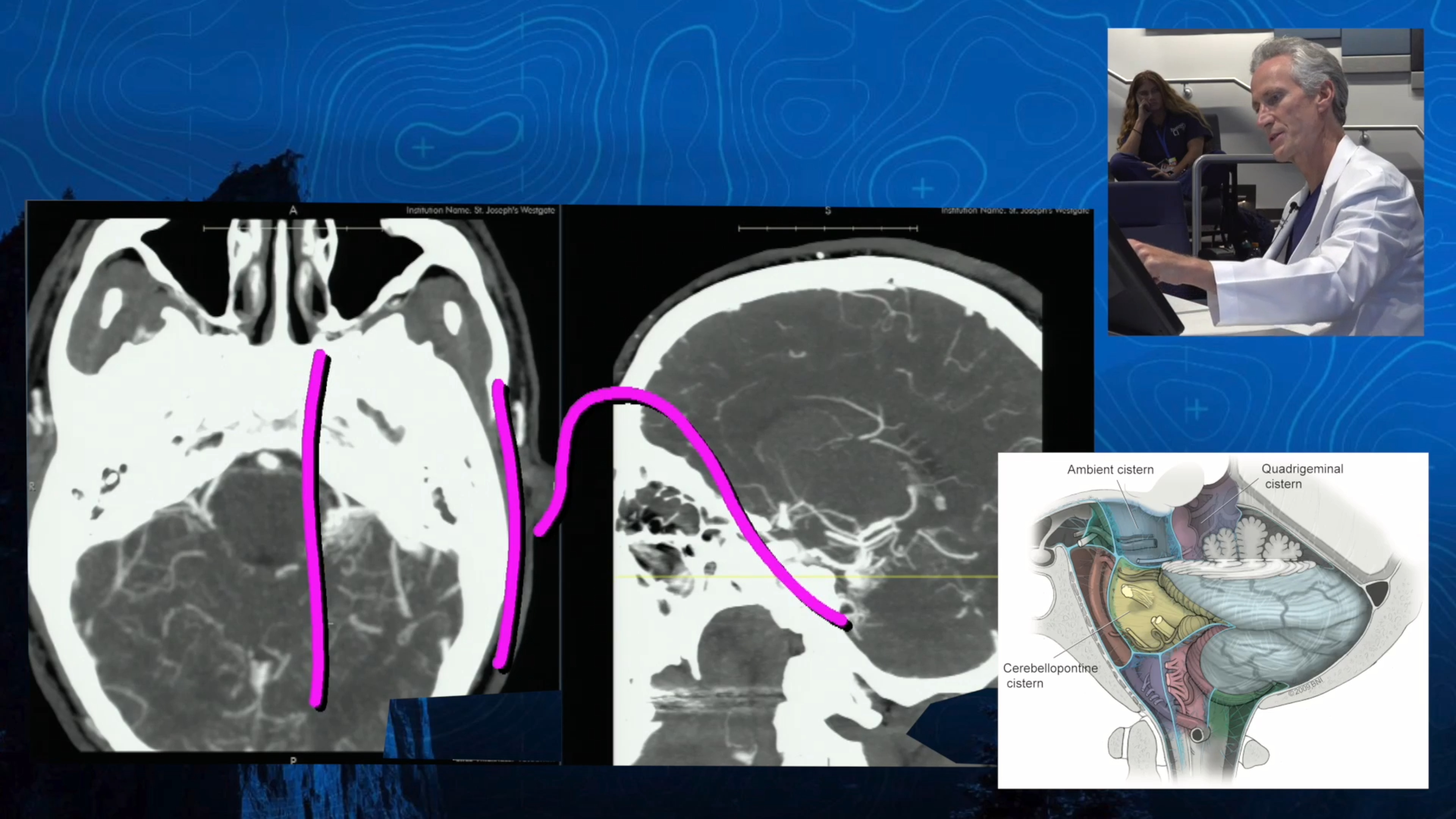 Episode 11: Intuition - Facial Nerve Microvascular Decompression