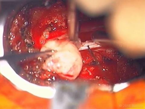 BQ_26-1_MIS intradural extramedullary_Video 1