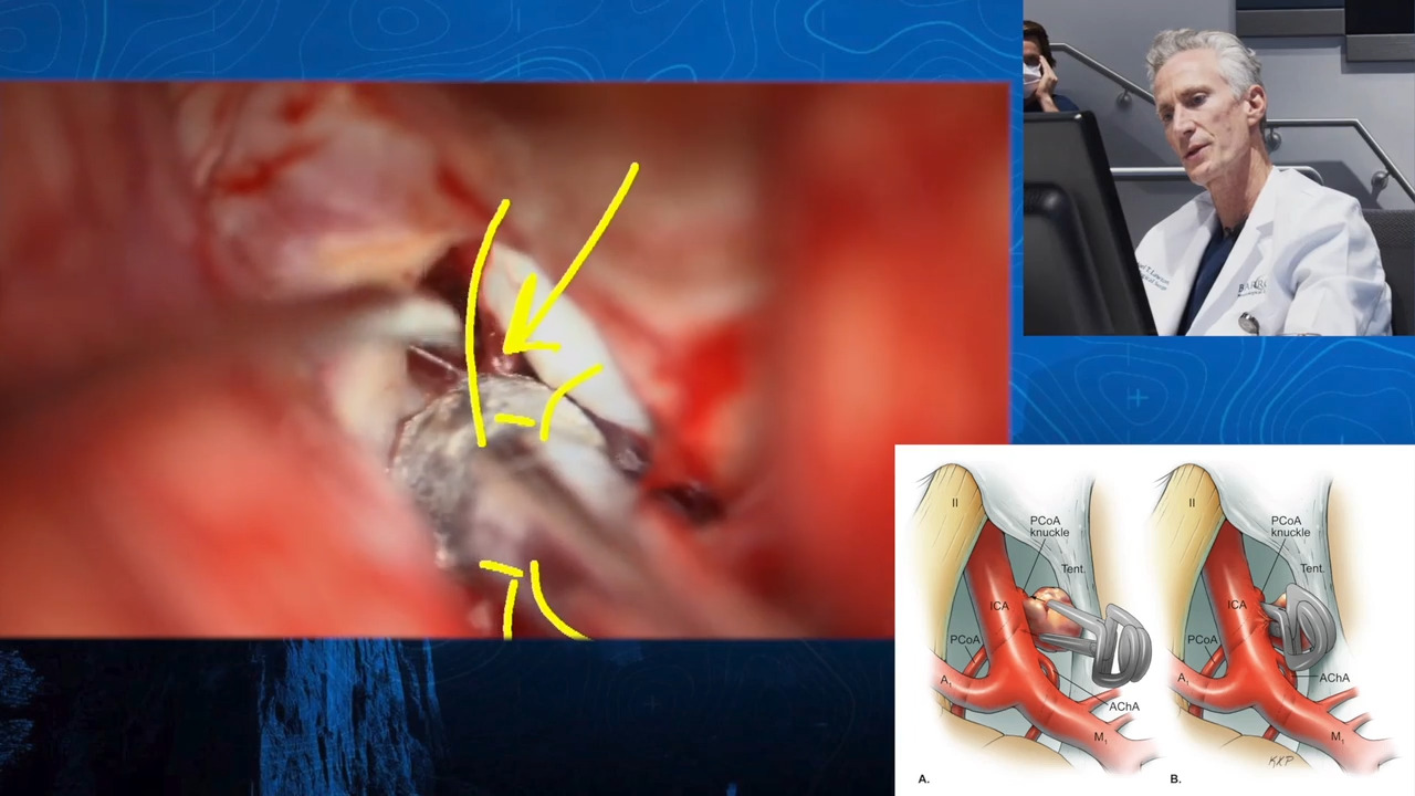 Episode 14: Clipping of a Ruptured Posterior Communicating Artery Aneurysm