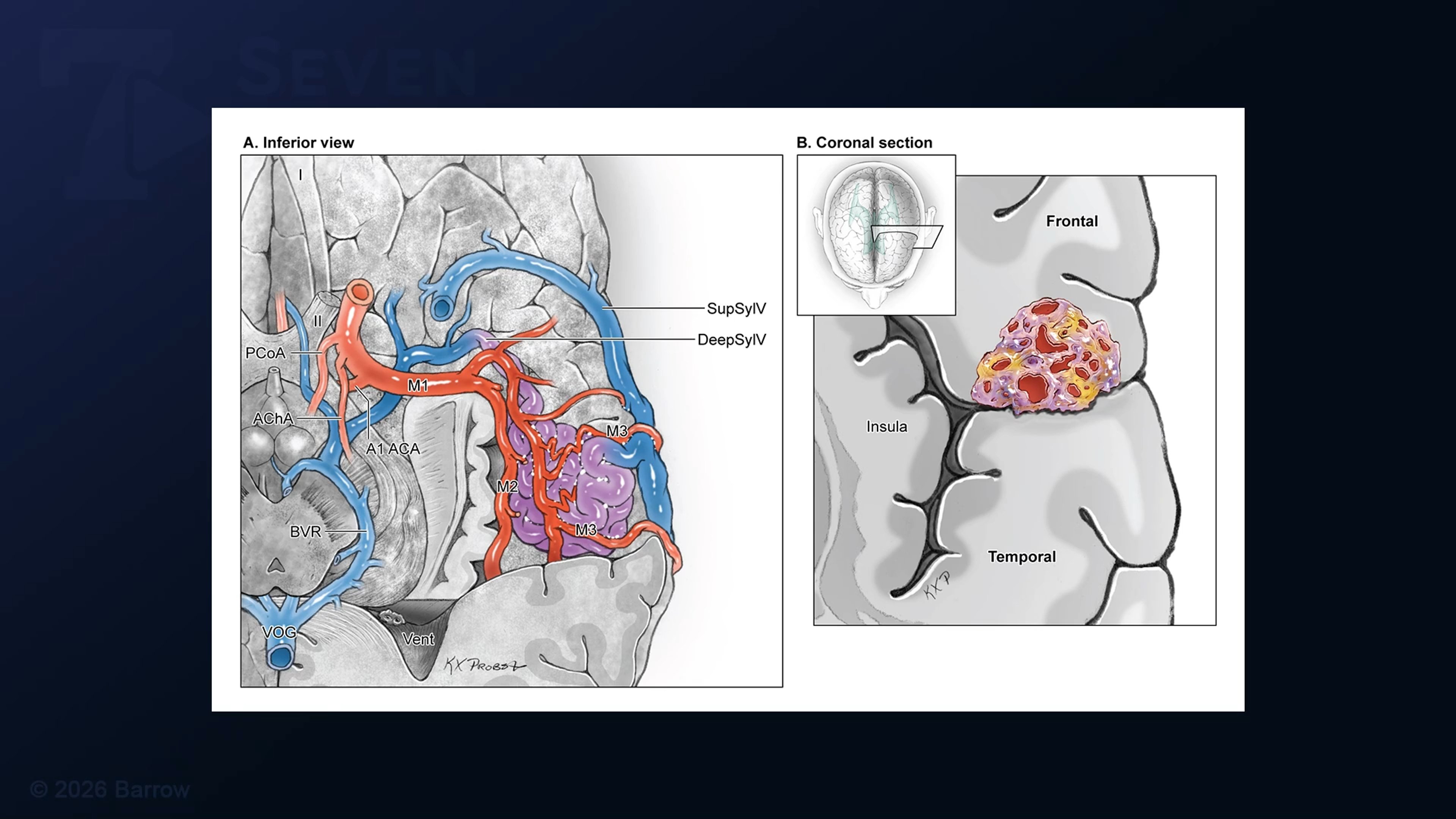 #551: Temporoparietal Craniotomy for Resection of a Distal Frontal Sylvian Arteriovenous Malformation