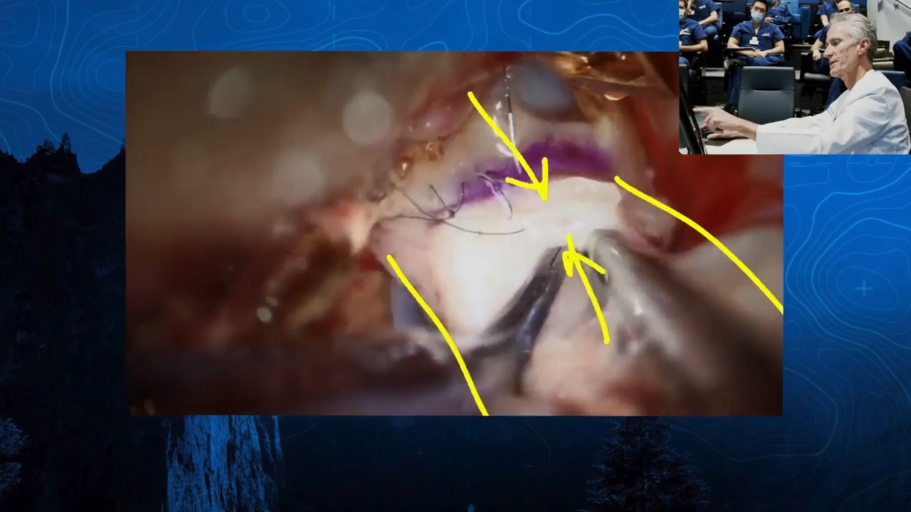 Episode 12 Part 2: Giant Anterior Communicating Artery Aneurysm with A3-A3 Bypass
