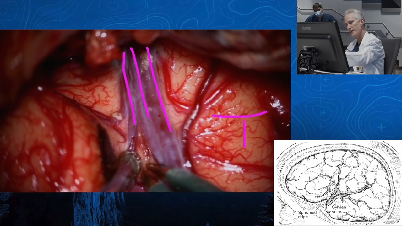 Episode 13: Internal Carotid Artery (ICA) Terminus Aneurysm