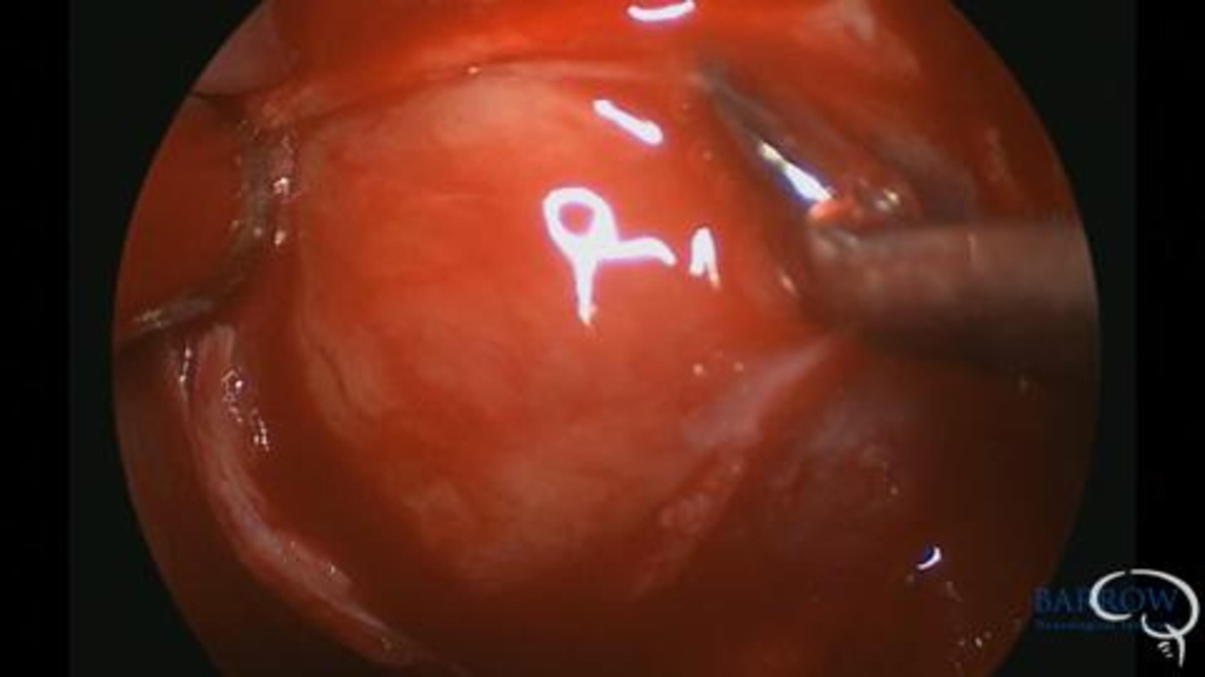 Removal of Pituitary Adenoma Leaving Tumor Pseudocapsule Intact