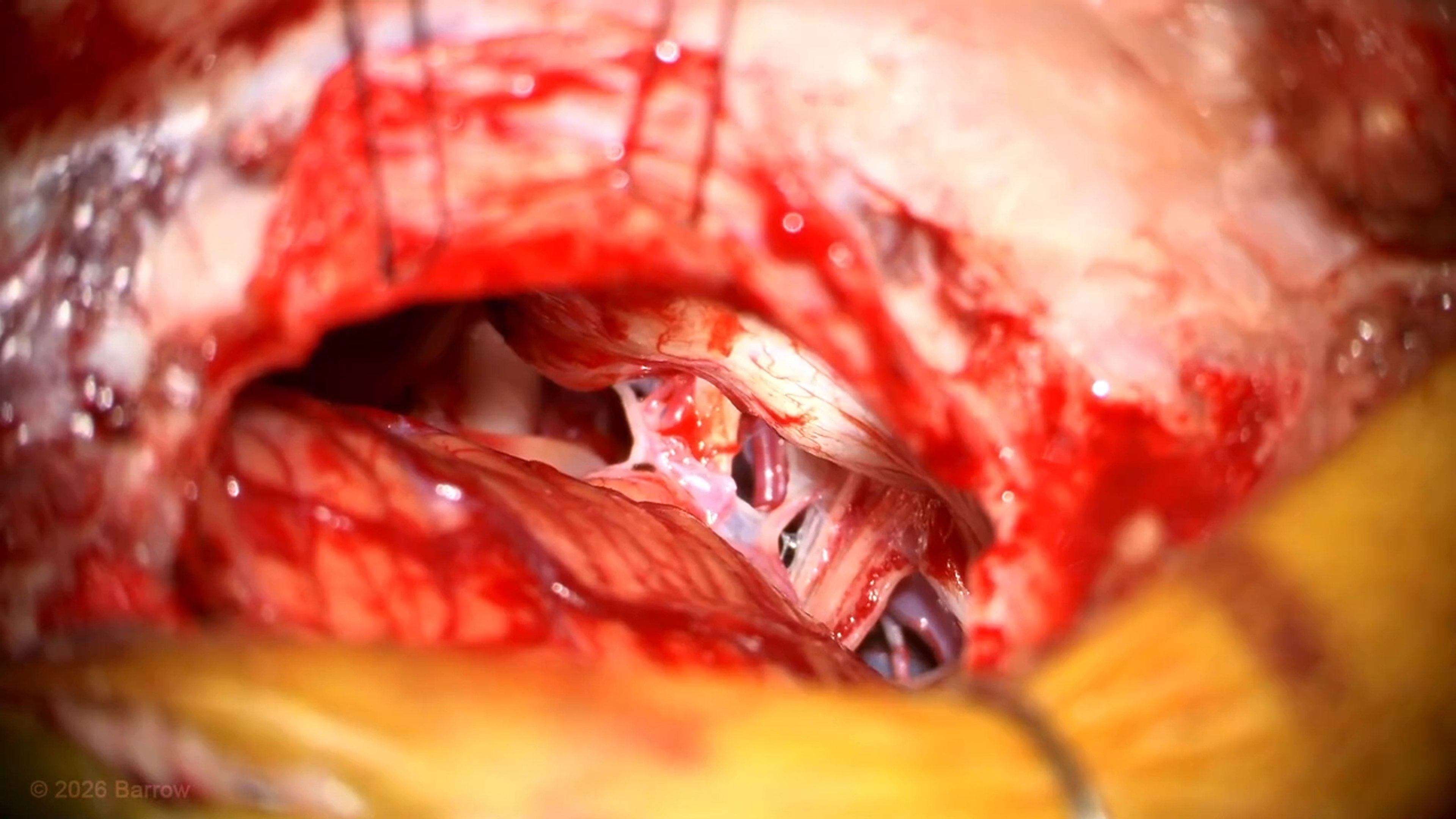 #556: Extended Retrosigmoid Craniotomy and Obliteration of a Superior Petrosal Sinus Dural Arteriovenous Fistula