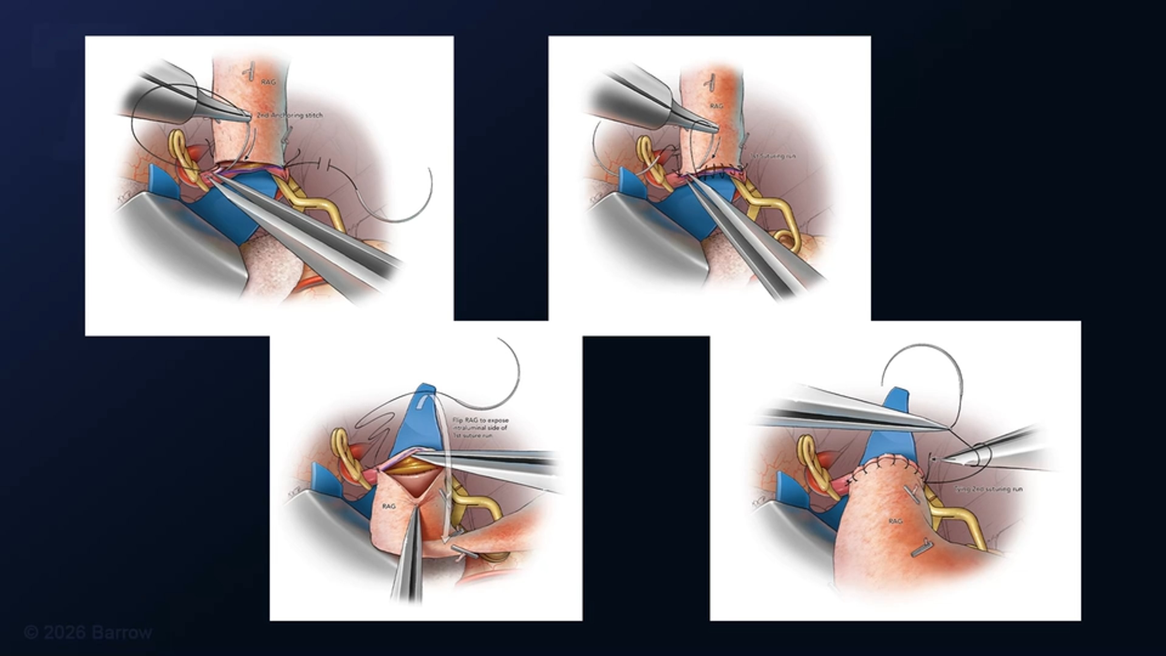 #563: Treatment of a Residual Stent-Coiled Supraclinoid Internal Carotid Artery Aneurysm with a CCA-RAG-M2 Interpositional Bypass and Proximal Clip Occlusion