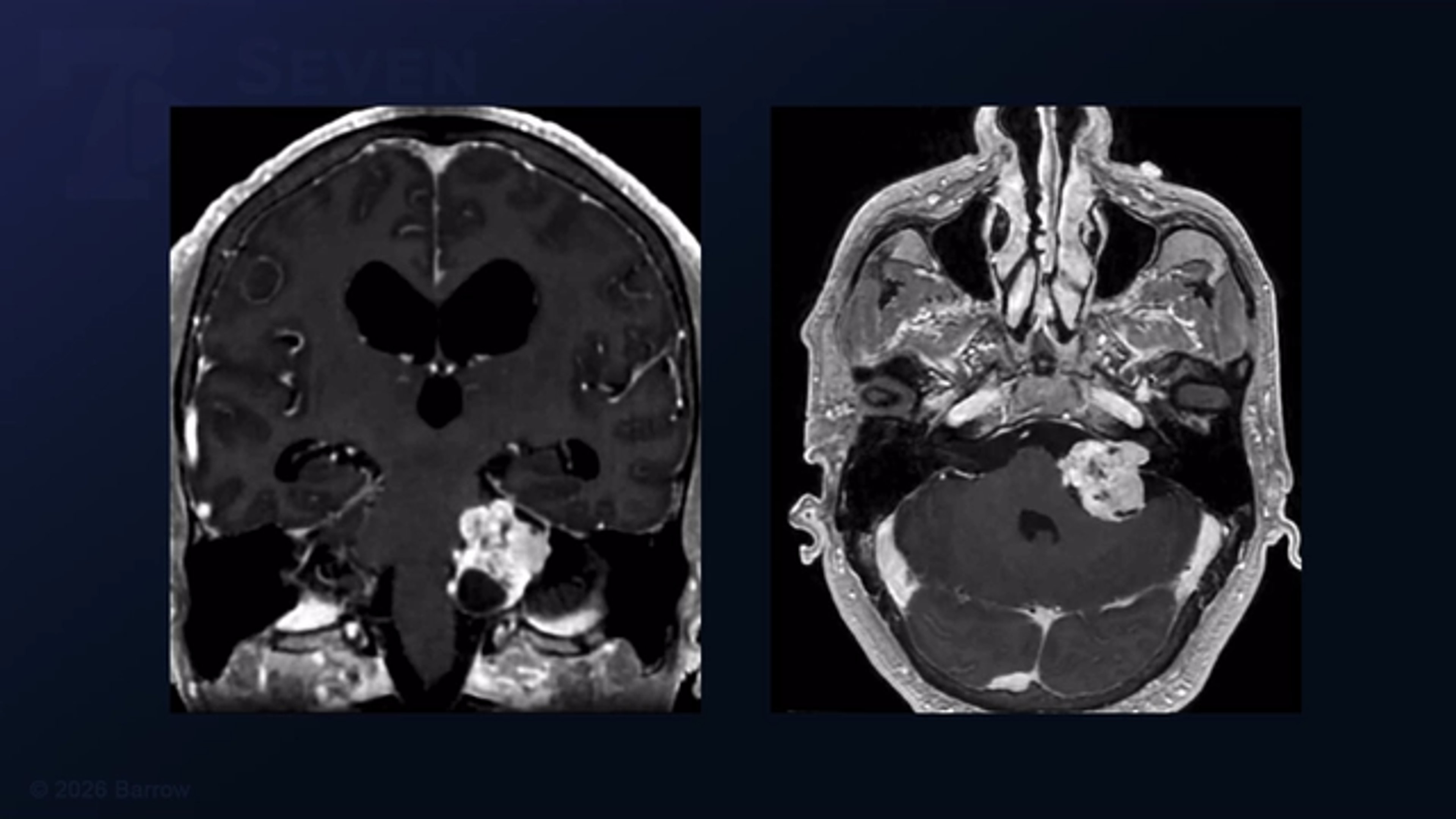#576: Extended Retrosigmoid Craniotomy for Resection of a Vestibular Schwannoma 