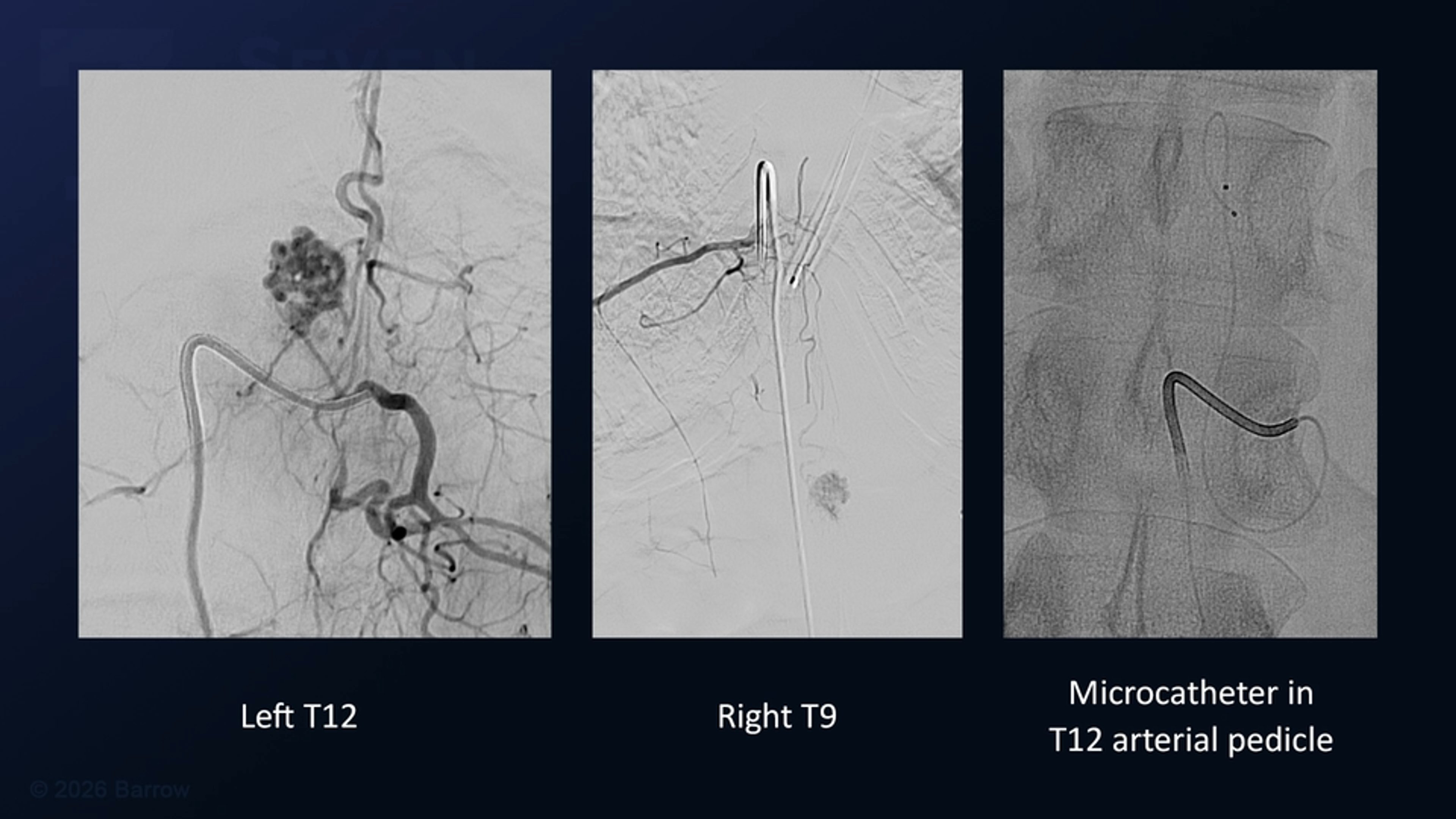 #555: Microsurgical Resection of a T12 Intramedullary Spinal Arteriovenous Malformation