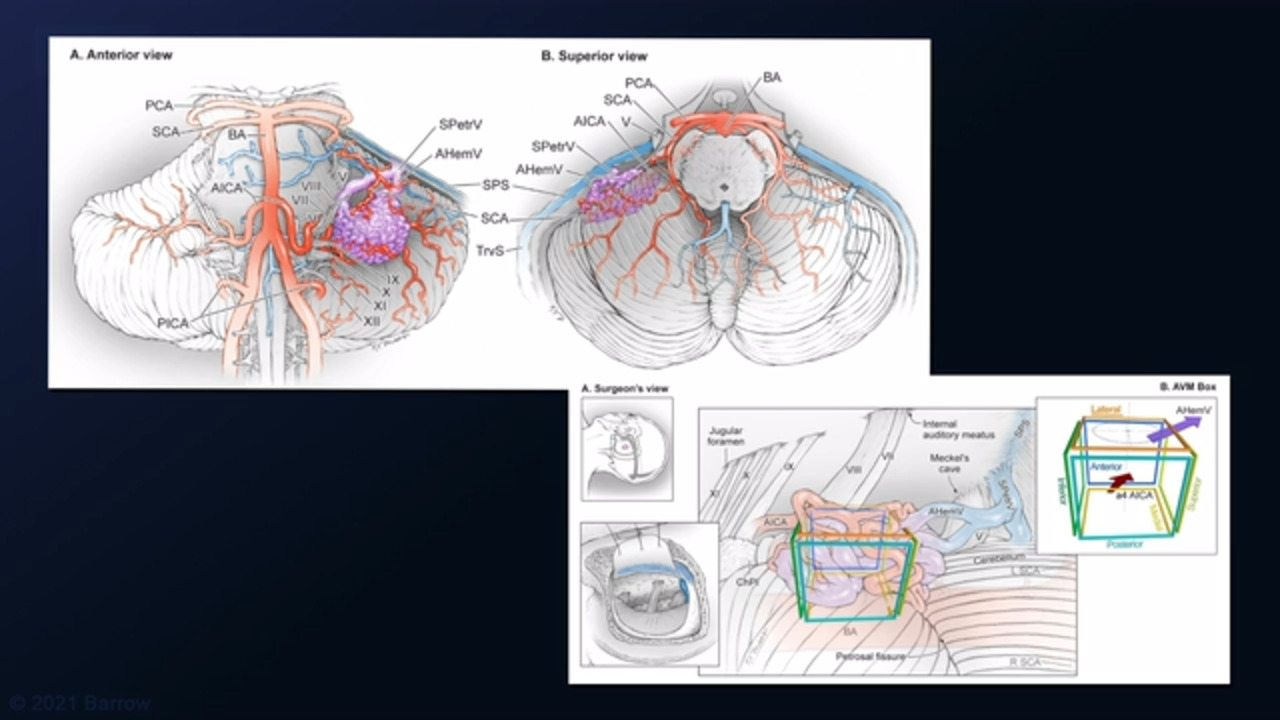 #36: Extended Retrosigmoid Approach for Resection of Grade III Cerebellomesencephalic AVM with Microvascular Decompression for Hemifacial Spasm