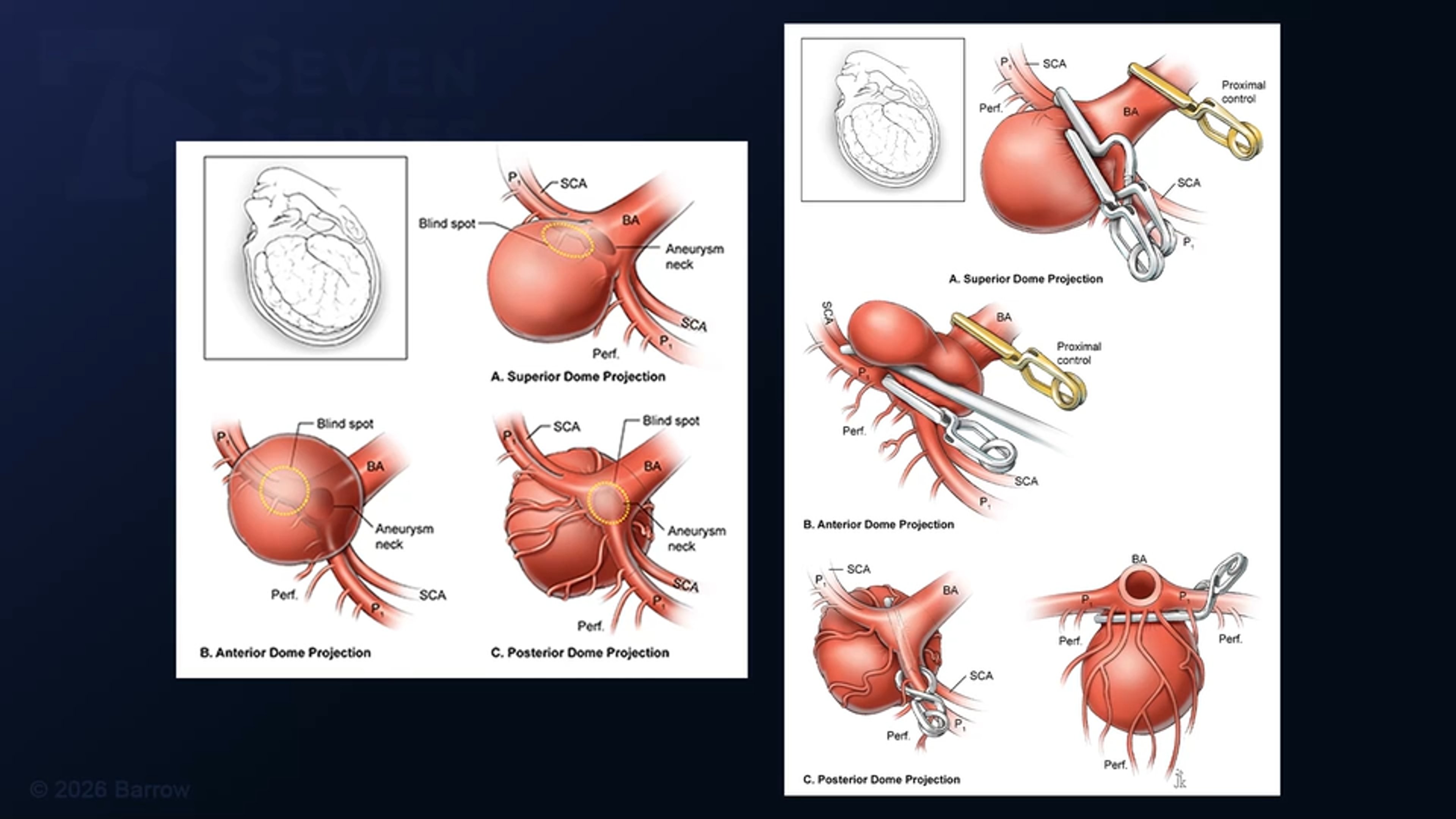 #575: The "Hat Trick": Contralateral Clipping of an MCA Aneurysm with Clipping of Basilar Bifurcation and Ipsilateral MCA Aneurysms