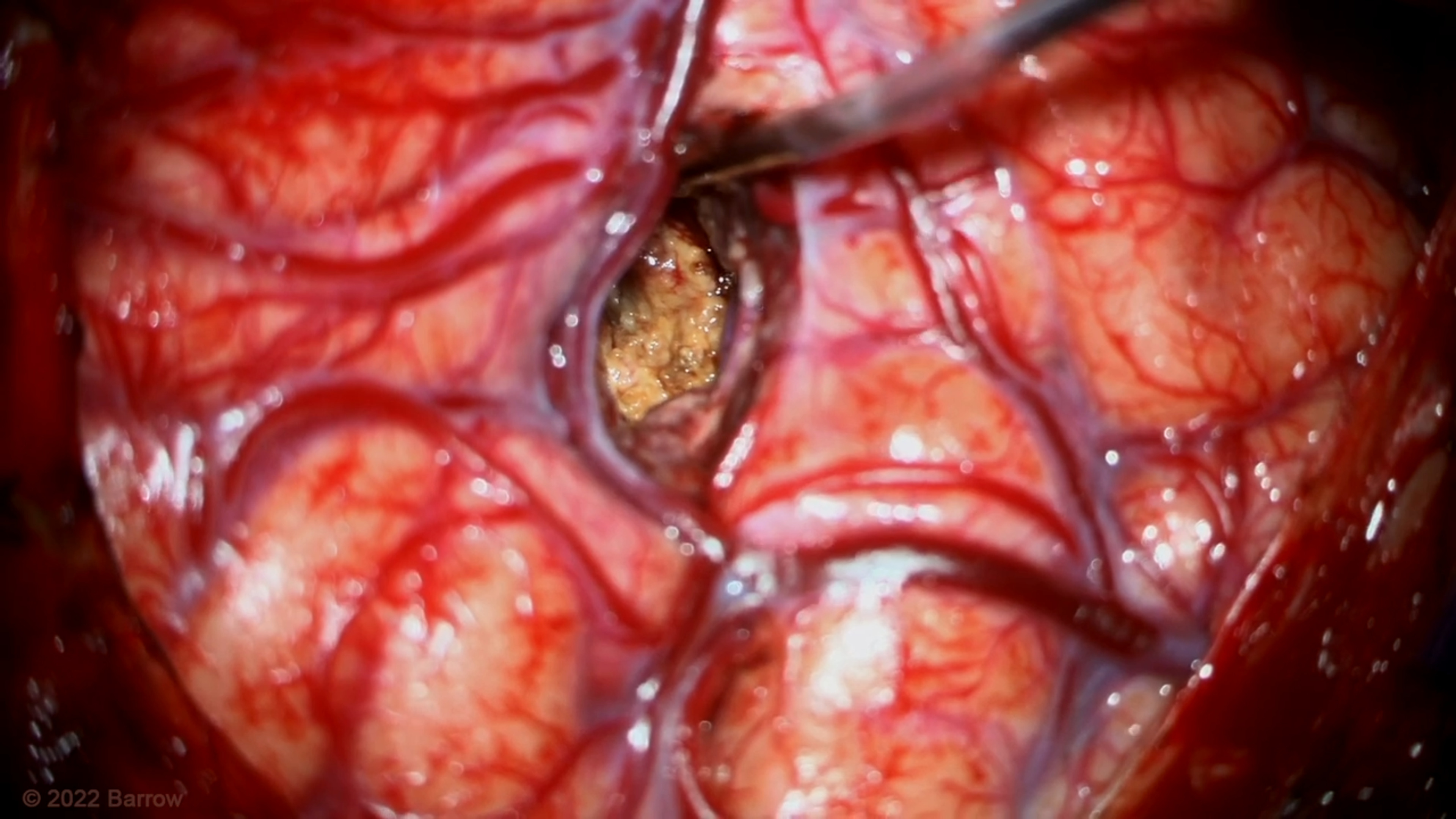 #150: Pterional Craniotomy and Transsylvian-Transinsular Approach for Resection of Insular Lateral Thalamic Cavernous Malformation