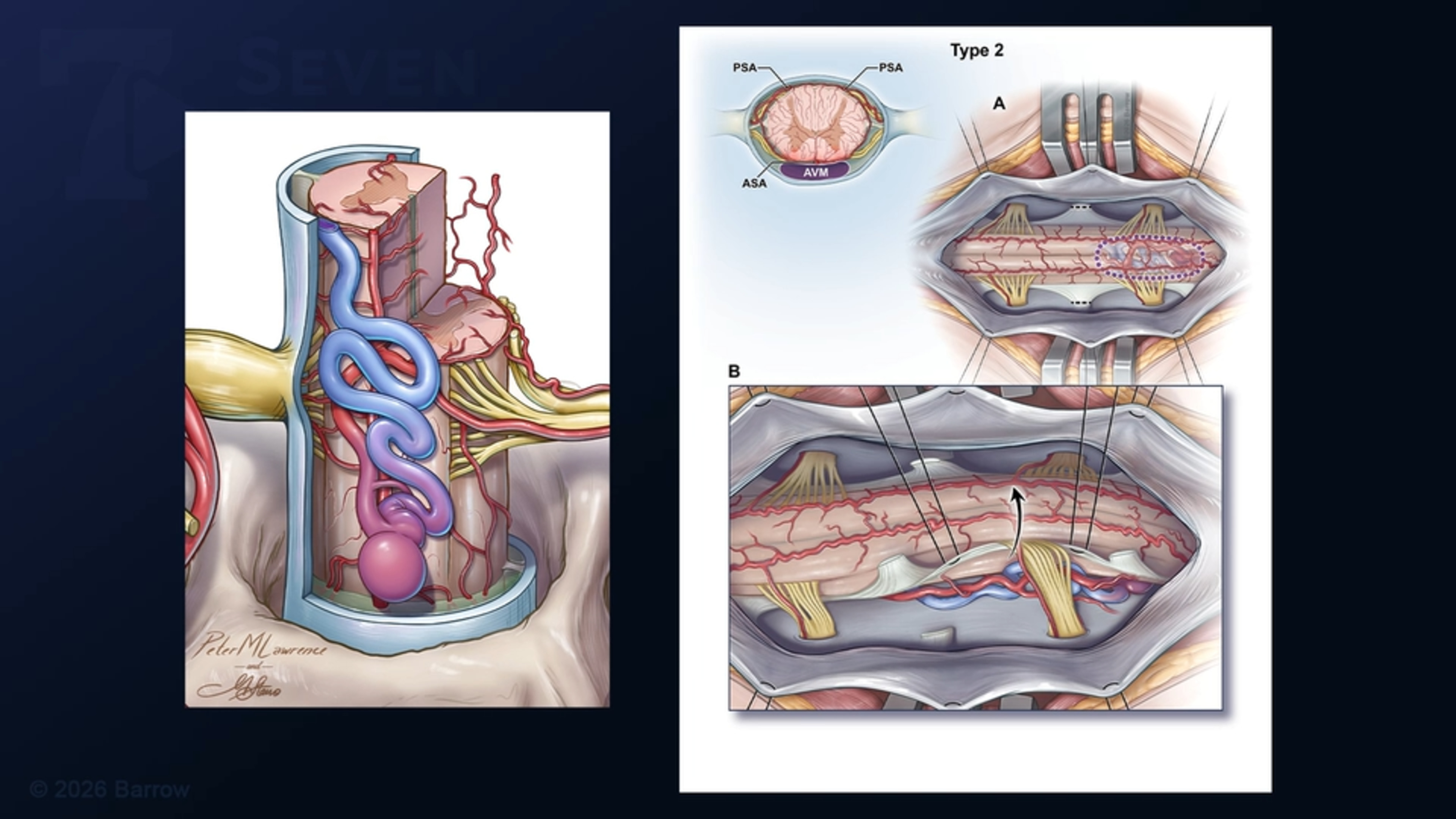 #536: Microsurgical Resection of an Anterior Perimedullary Spinal Arteriovenous Malformation