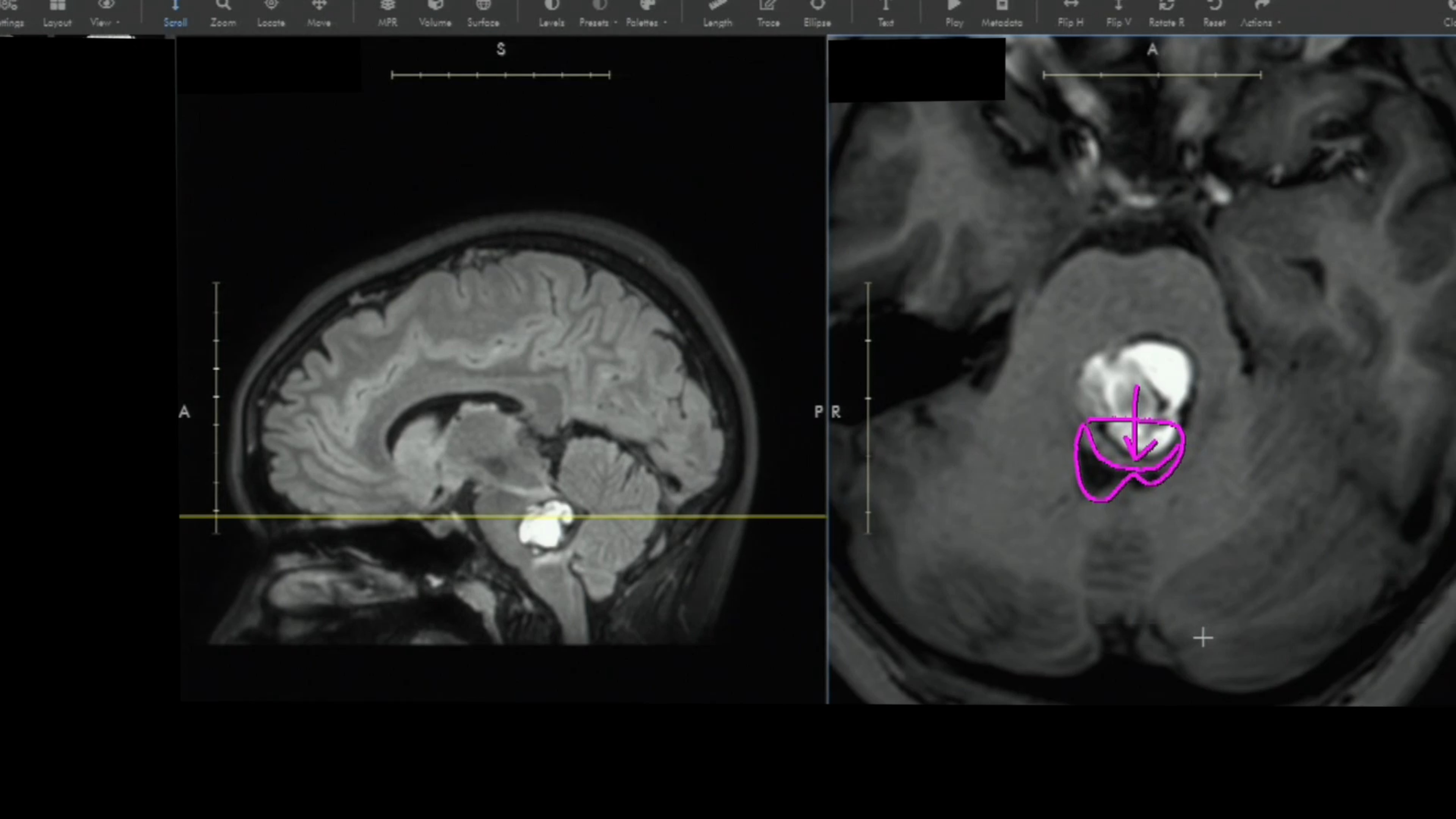 Episode 4: Uh Oh - Safe Entry Zones for Lesions of the Brainstem