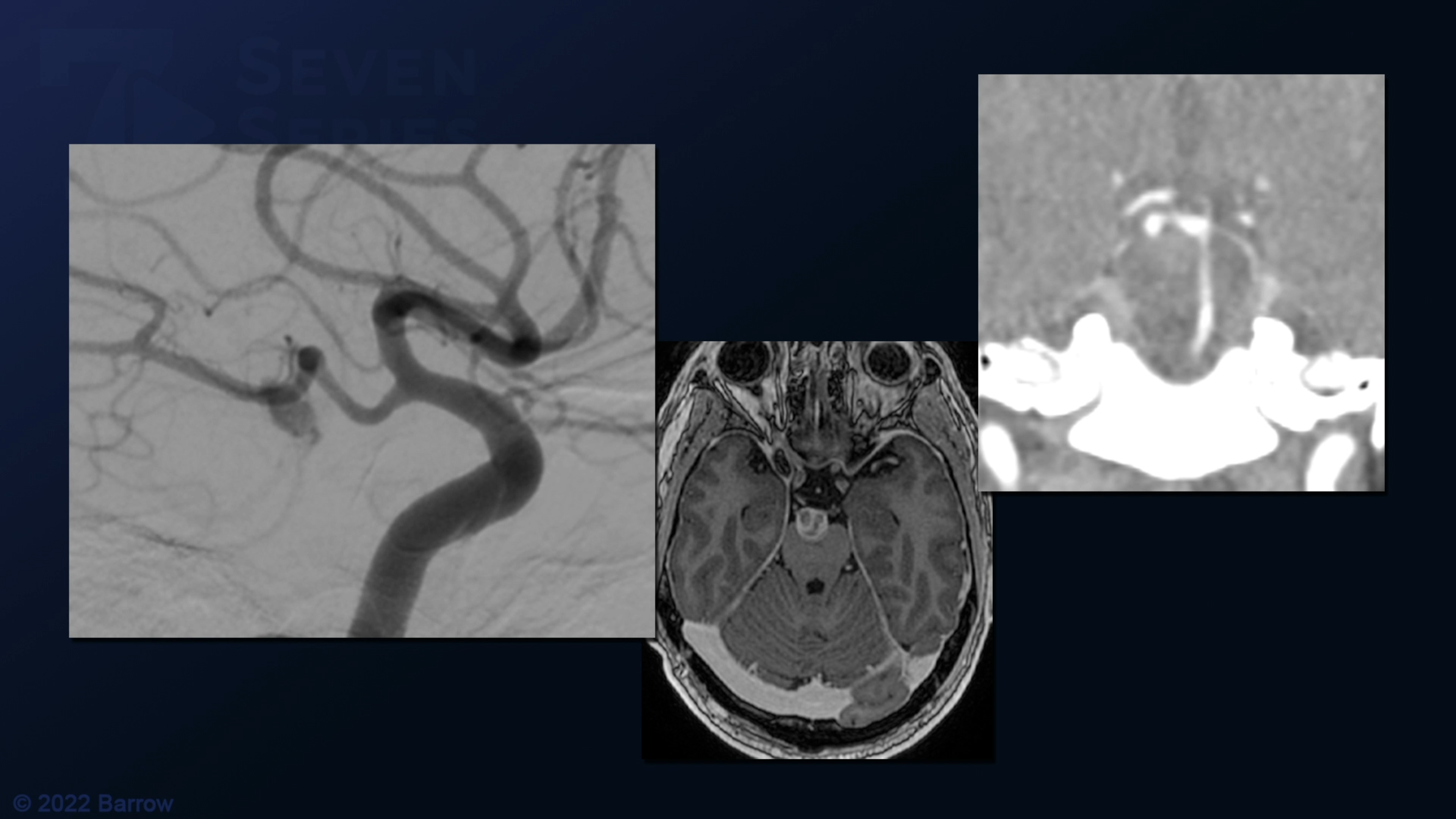 #125: Thrombotic Superior Cerebellar Artery Aneurysm Treated with STA-s2 SCA Bypass and Distal Clip Occlusion