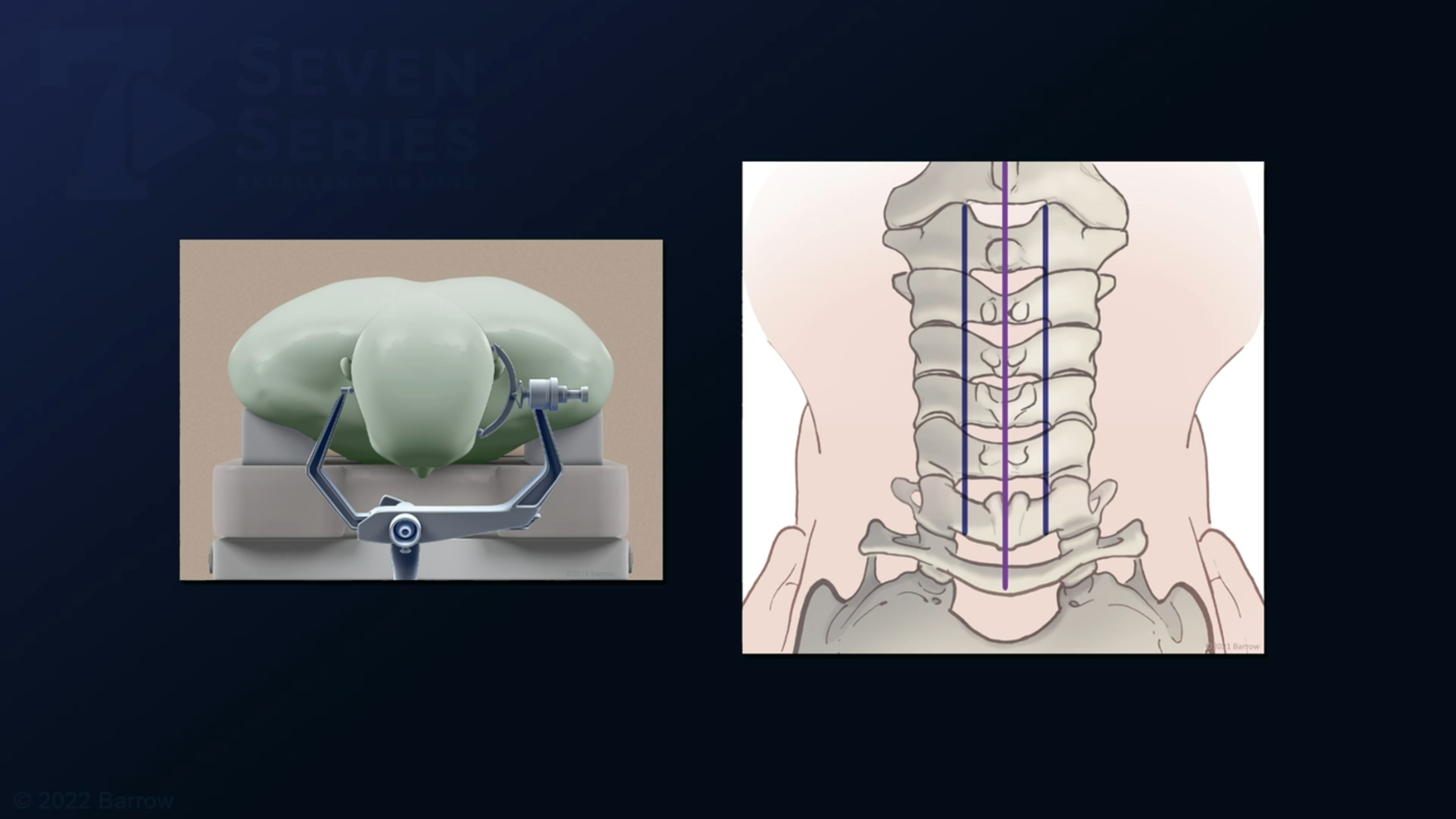 #178: Pial Resection Technique for an Eccentric Intramedullary Cervical Spinal Cord Arteriovenous Malformation