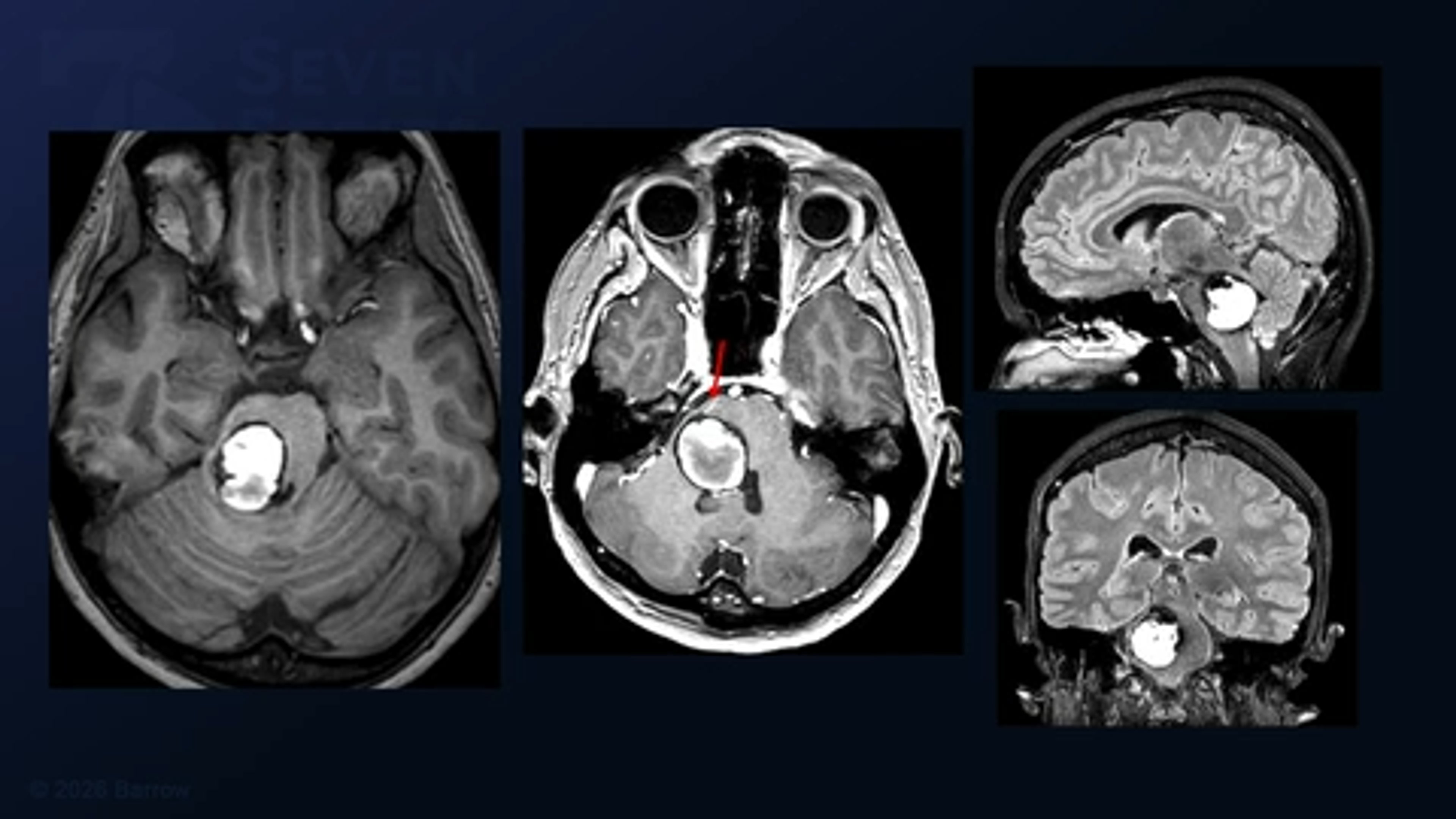 #578: Trans-Middle Cerebellar Peduncle Approach for a Middle Peduncular Pontine Cavernous Malformation Resection