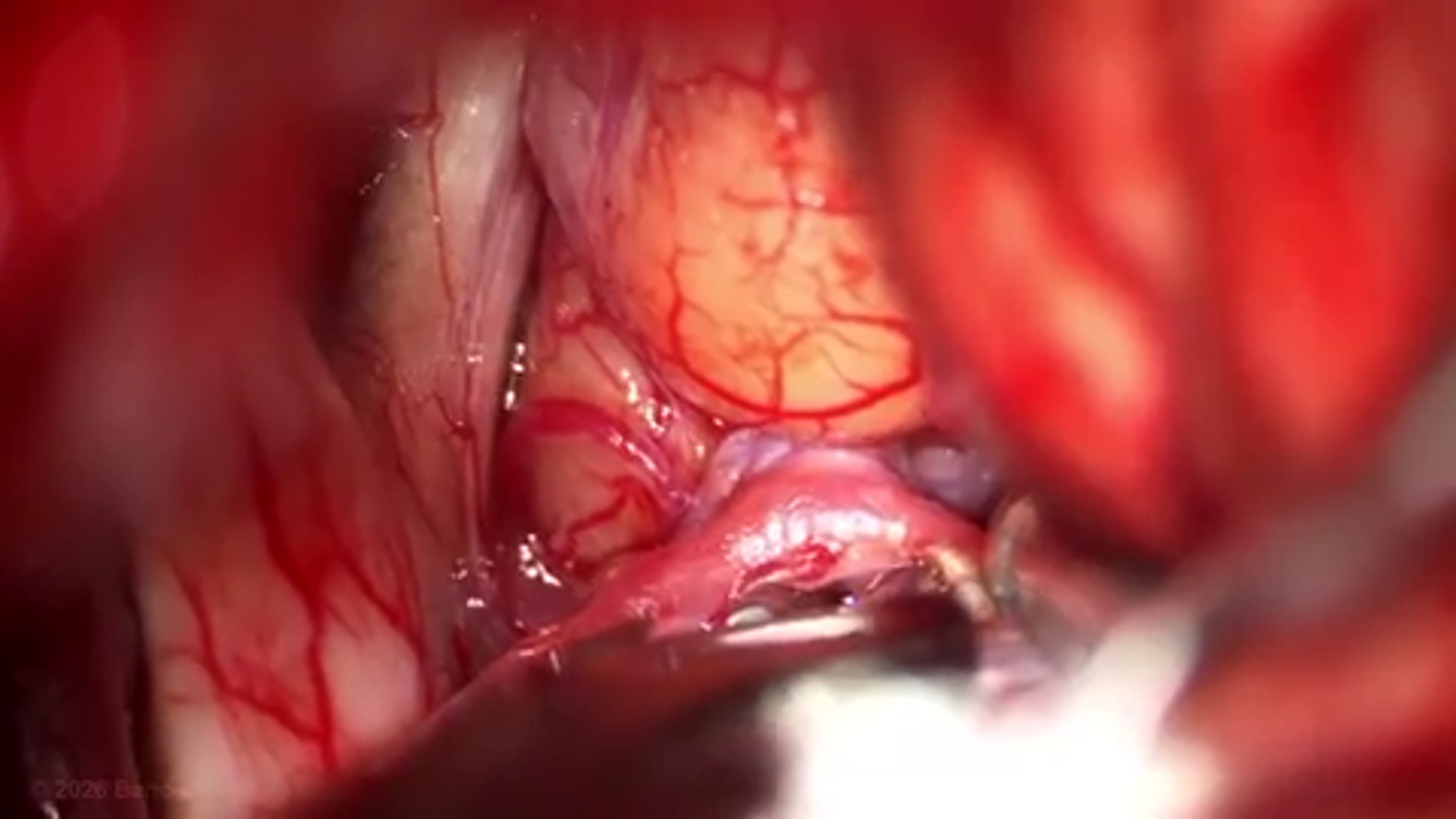 #559: Pterional Craniotomy for Clipping of a Thrombotic Anterior Communicating Artery Aneurysm