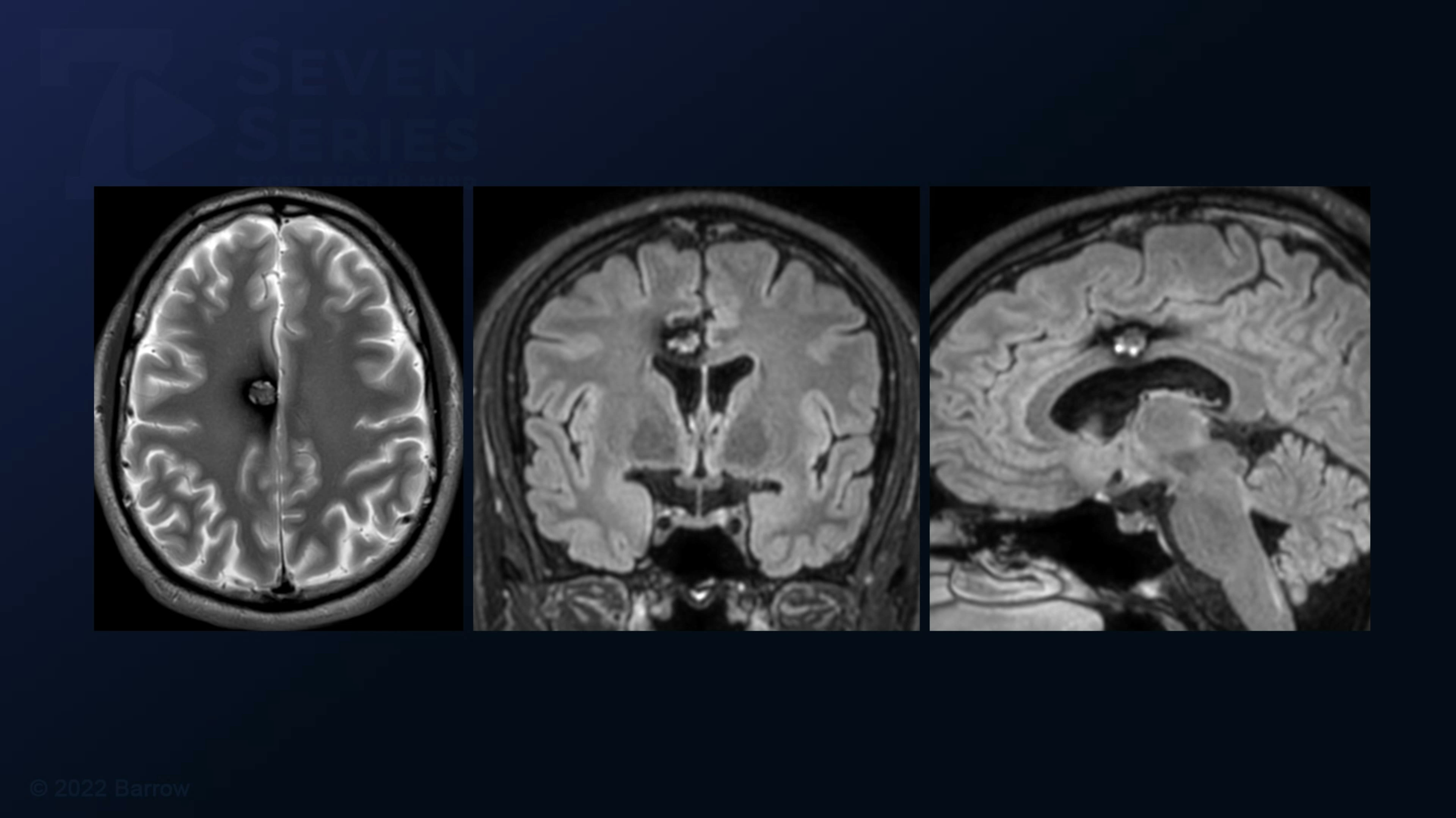 #152: Anterior Interhemispheric Ipsilateral Transcingulate Approach For ...