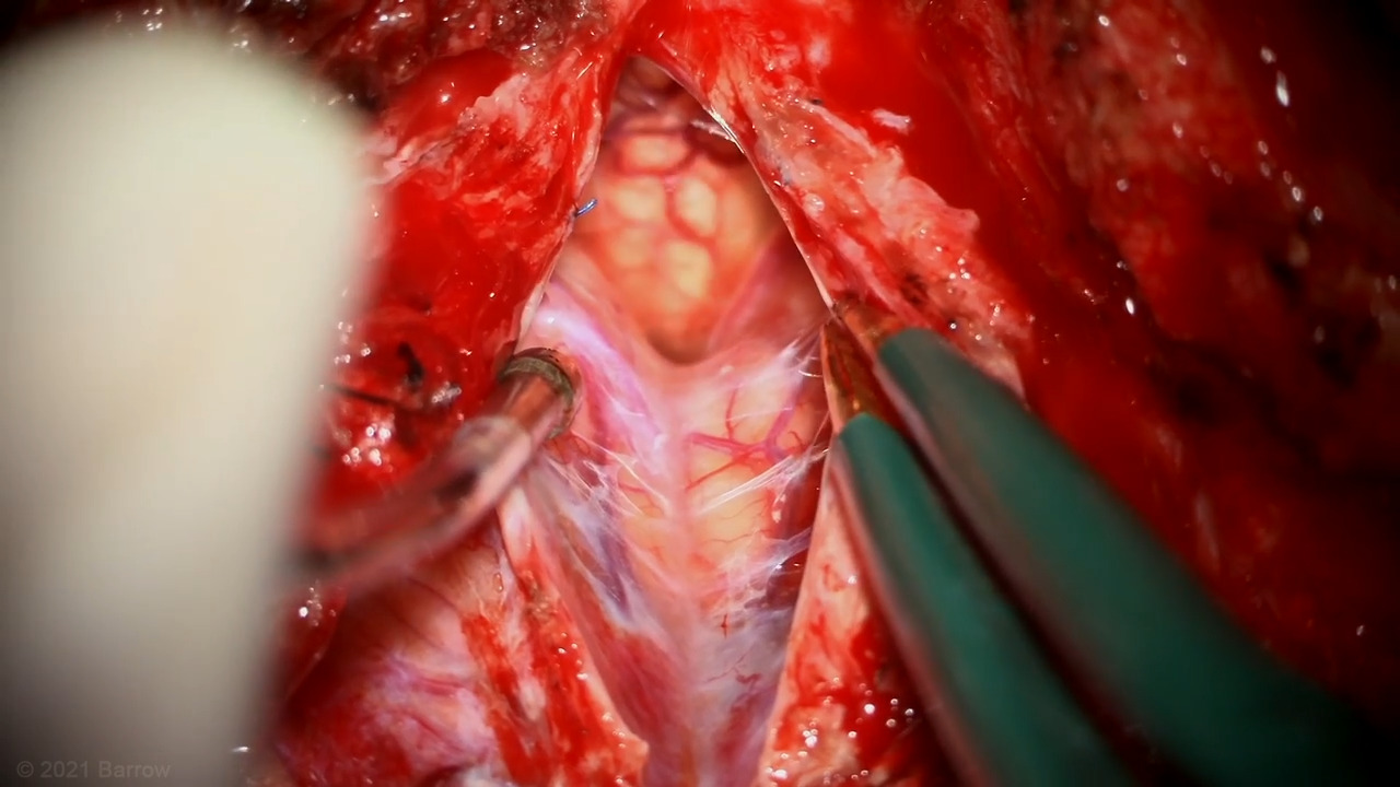 #3: Suboccipital Telovelar Approach for Inferior Cerebellar Peduncle Pontine Cavernous Malformation