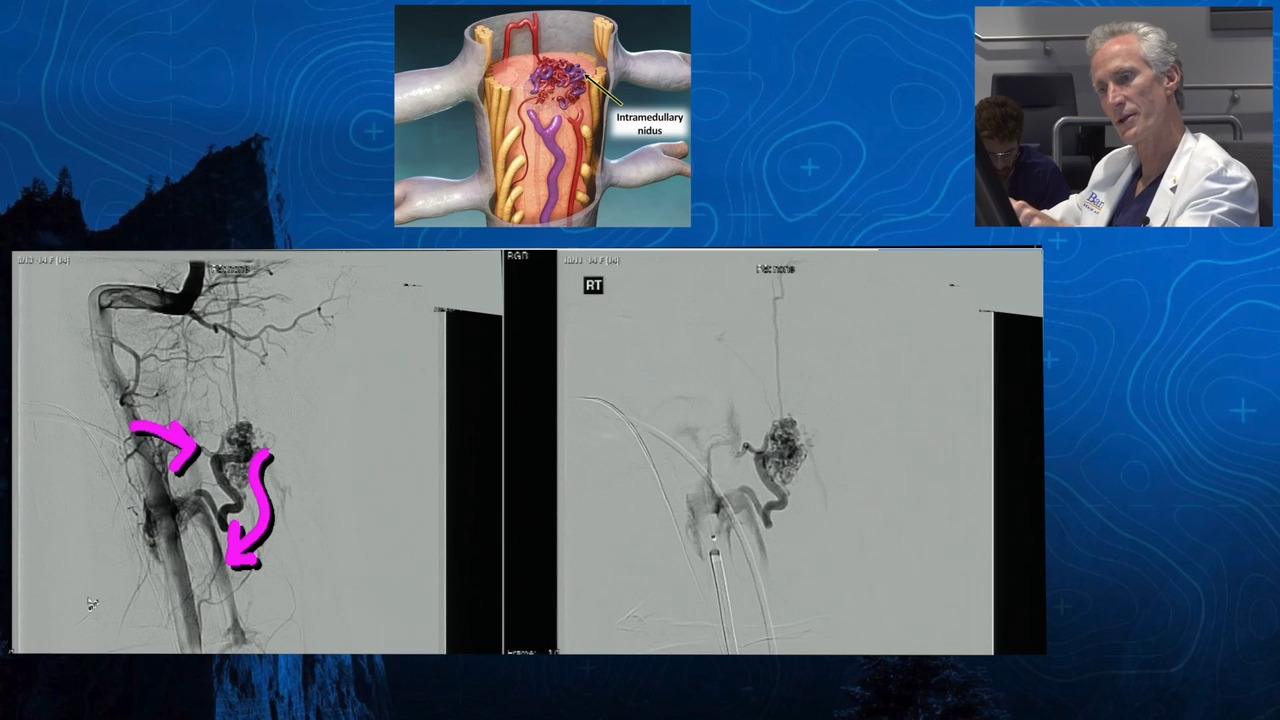 Episode 1: Hope - High Cervical Spinal Cord AVM