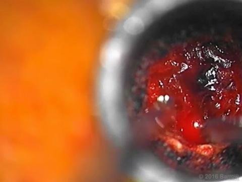 BQ_26-1_MIS foraminotomy_Video 2