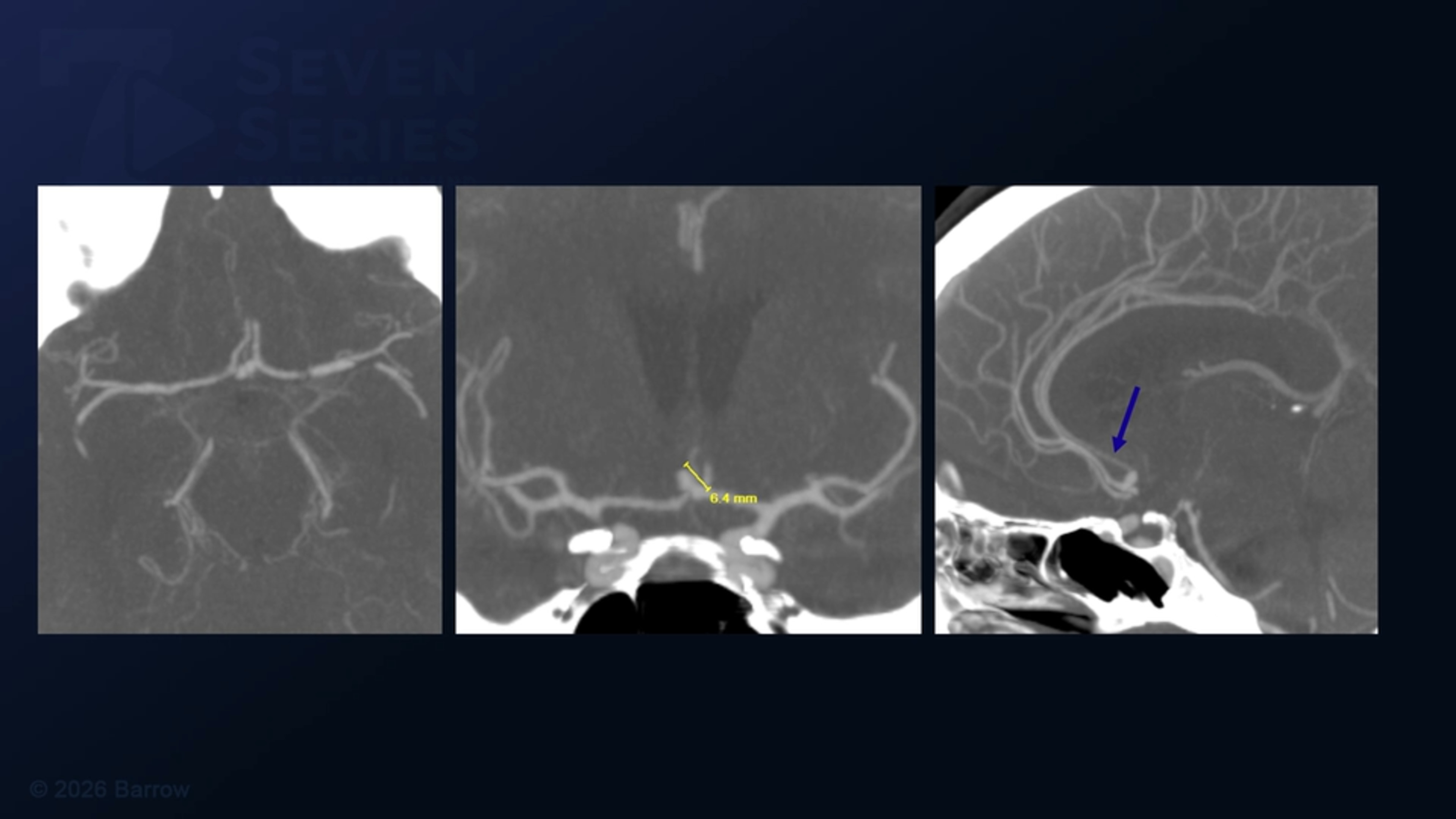 #546: Pterional Craniotomy for Clipping of a Ruptured Anterior Communicating Artery Aneurysm with an Accessory A2