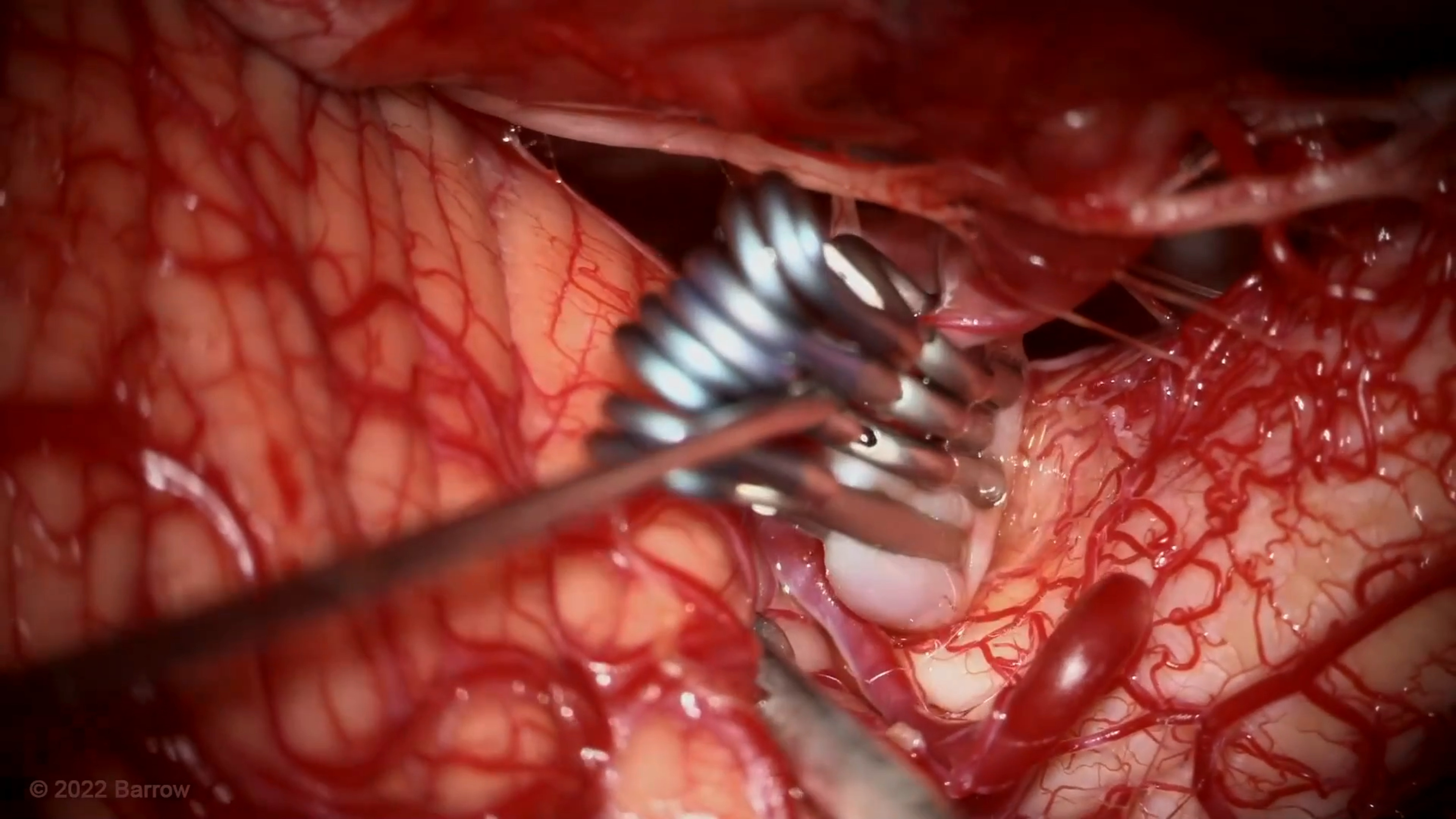 #153: Clip Reconstruction of a Posterior Inferior Cerebellar Artery Aneurysm with Anterograde Fenestration Tube