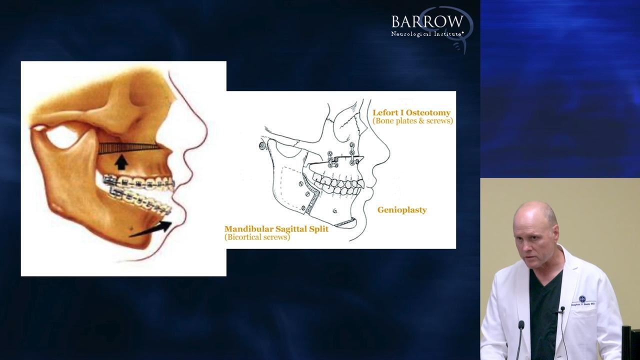 How Jaw Surgery is Performed