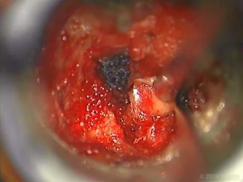 BQ_26-1_MIS foraminotomy_Video 1