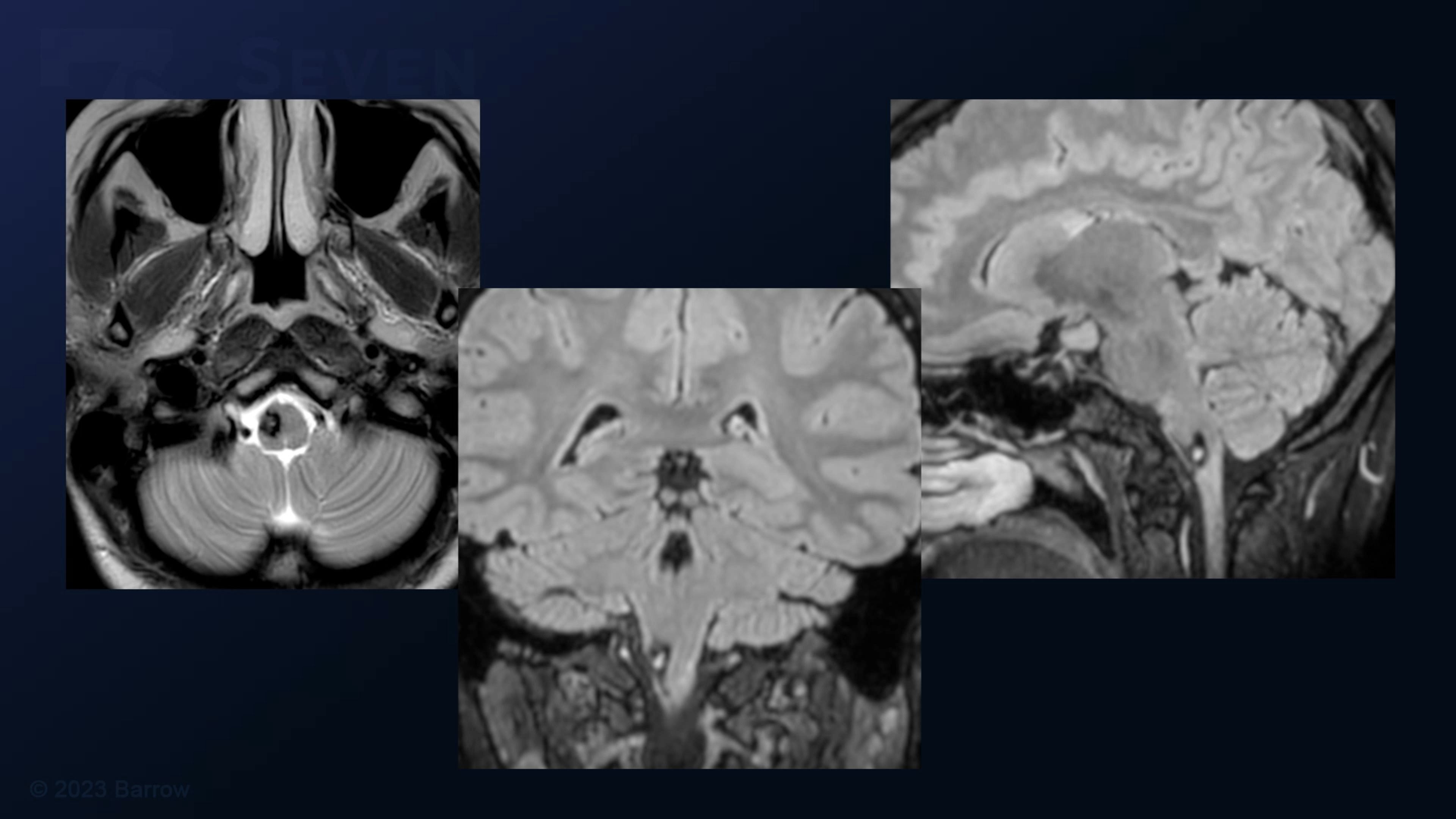 #217: Orbitozygomatic Craniotomy And Transsylvian-Transpeduncular ...