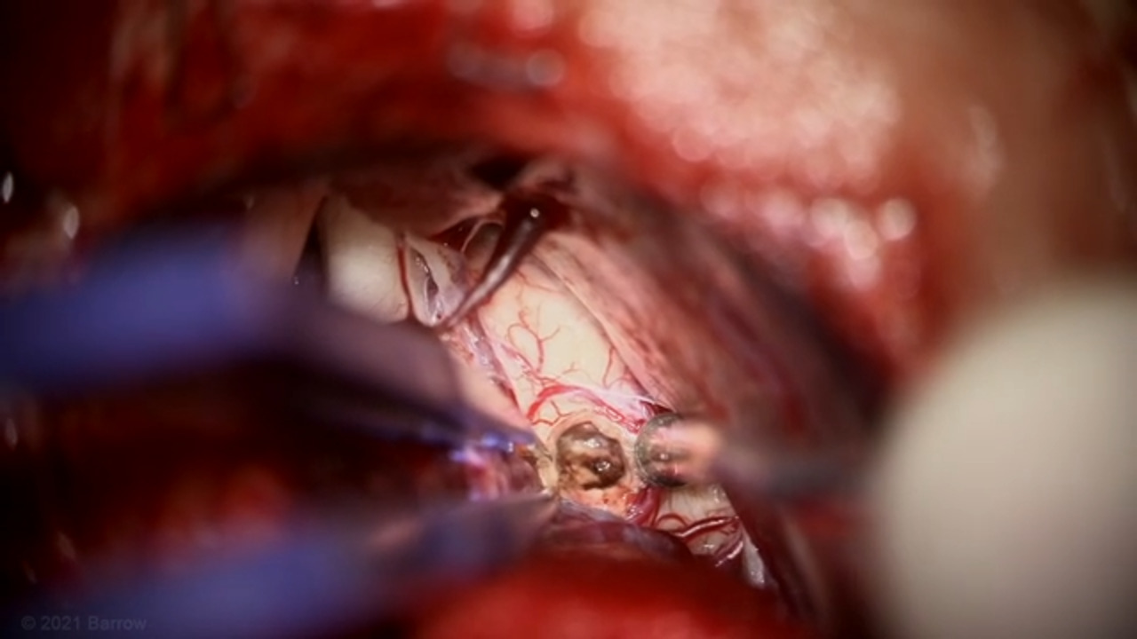 #48: Extended Retrosigmoid Craniotomy and Transcerebellar Pontine Angle Approach for Resection of Peritrigeminal Pontine Cavernous Malformation