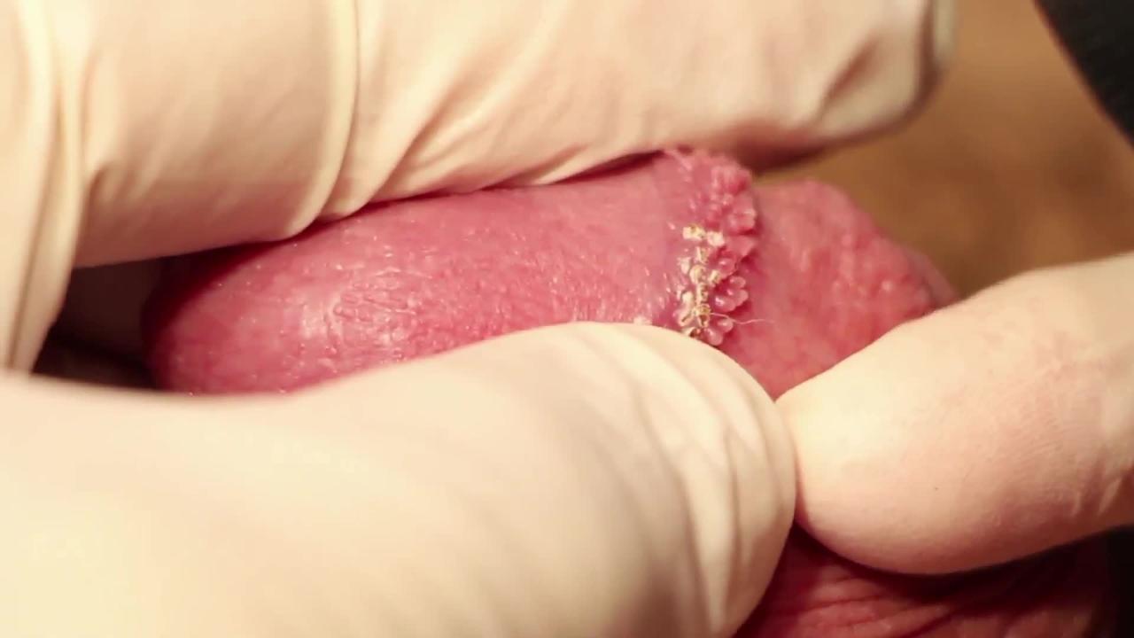 trolleybus Op de grond Uitmaken Dr. Groff Removes Pearly Penile Papules PPP with C02 Laser - Video -  RealSelf
