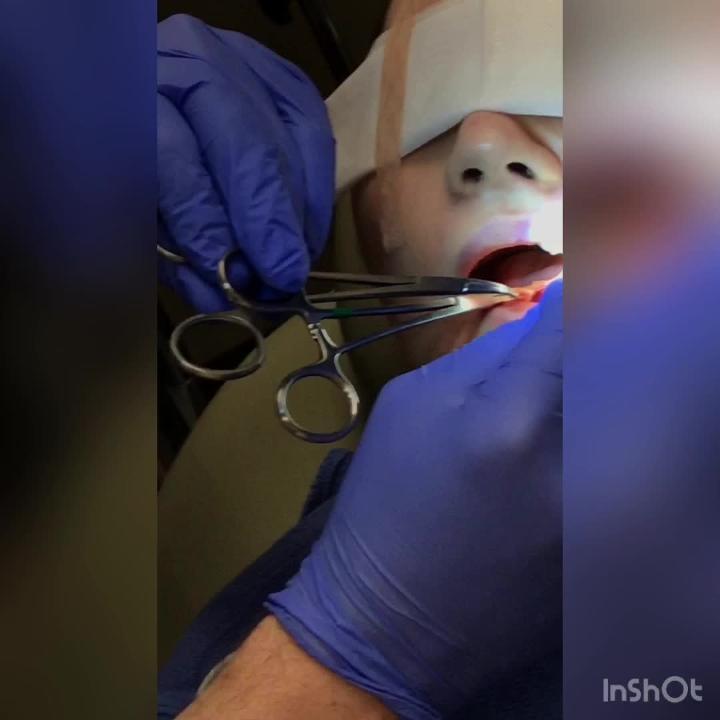 Buccal Fat Removal With Robb Graphic Video Realself