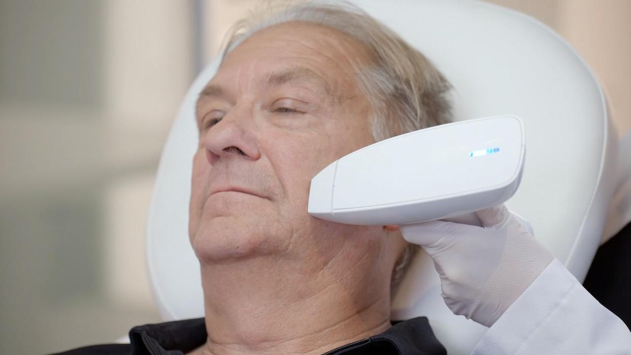 Acne Scars Laser Removal using Venus Viva Clinique Chloe Video