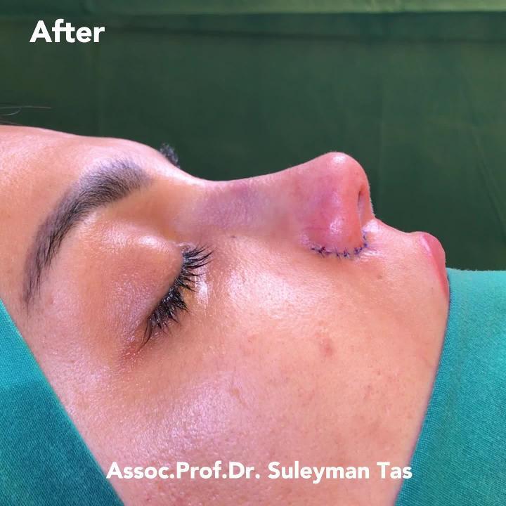 Celebrity Nose Closed Atraumatic Rhinoplasty with Alar Excision Assoc.Prof. Dr. Suleyman TAS TAS Aesthetic Surgery Clinic Istanbul Turkey Before and After