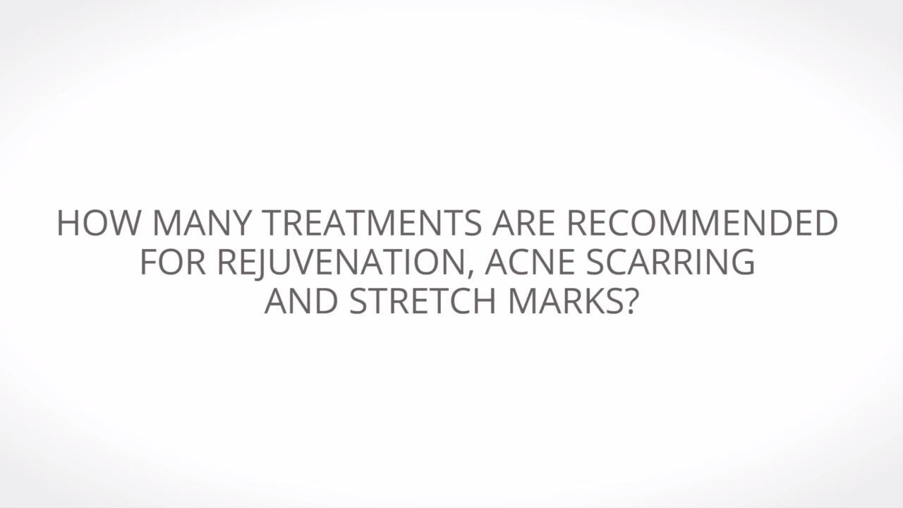 Stretch Marks? Acne Scars? Time to Learn About Dermapen - Video - RealSelf