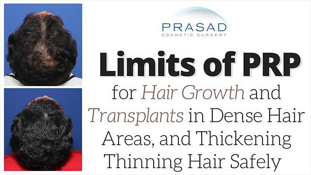 Limits of PRP in Hair Growth for Long-Term Results - Video - RealSelf