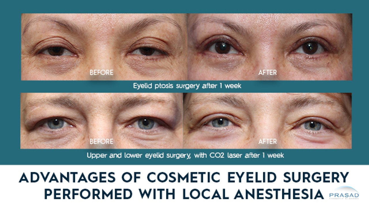 Advantages Of Eyelid Surgery Performed With Local Anesthesia Video Advantages Of Eyelid Surgery Performed With Local Anesthesia Video