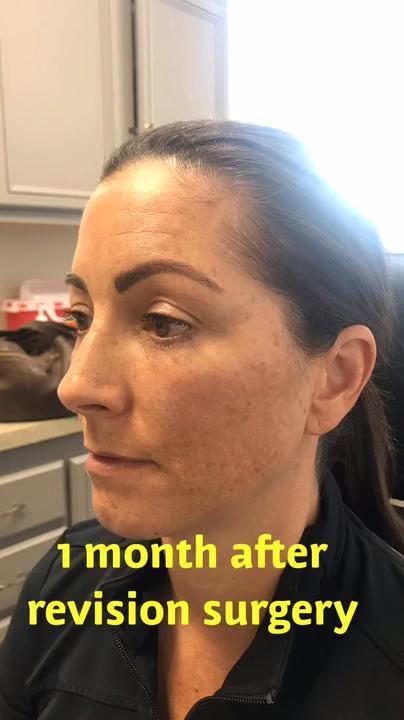 removal-of-fat-injection-lumps-under-eyes-video-realself