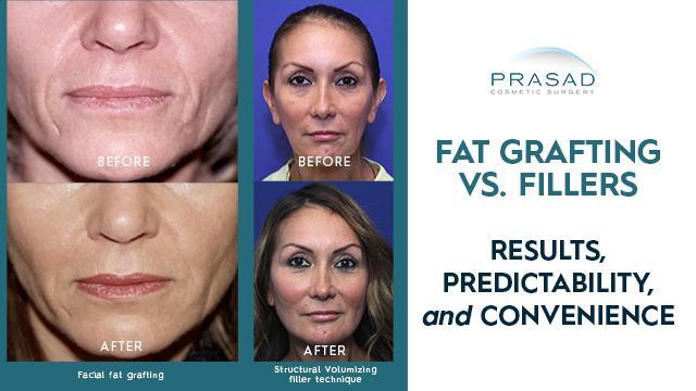 Factors In Choosing Between Facial Fat Grafting Or Injectable Fillers ...