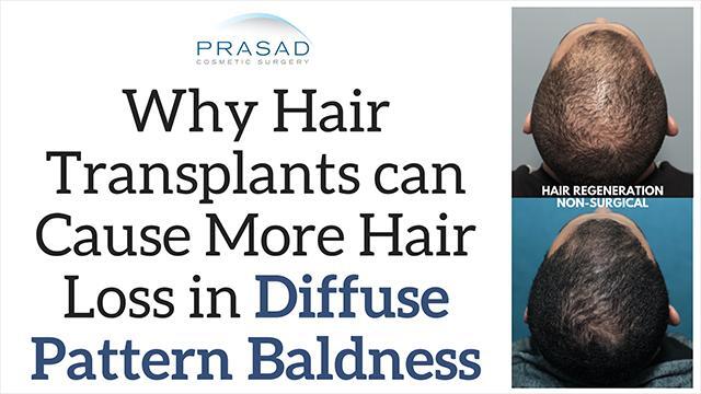 Why Hair Transplants in Diffuse Hair Loss Cases can Cause Greater Hair Loss  - Video - RealSelf