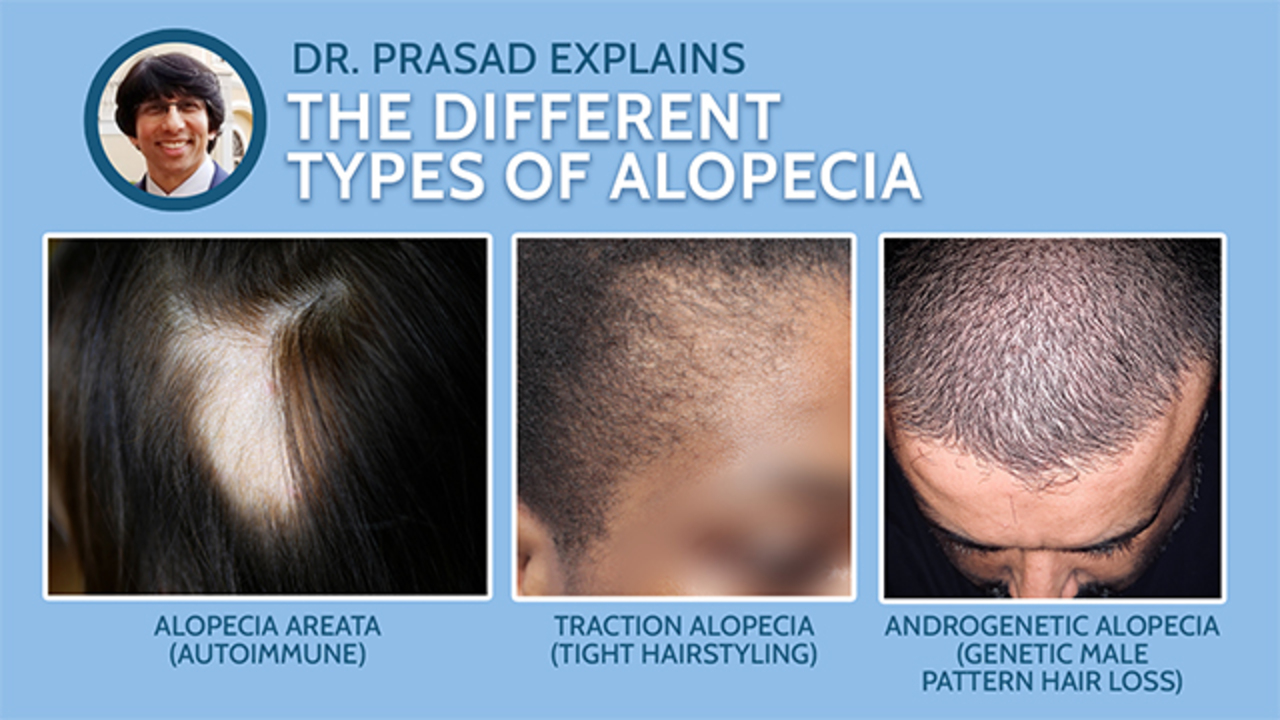 Different Types Of Alopecia Video RealSelf