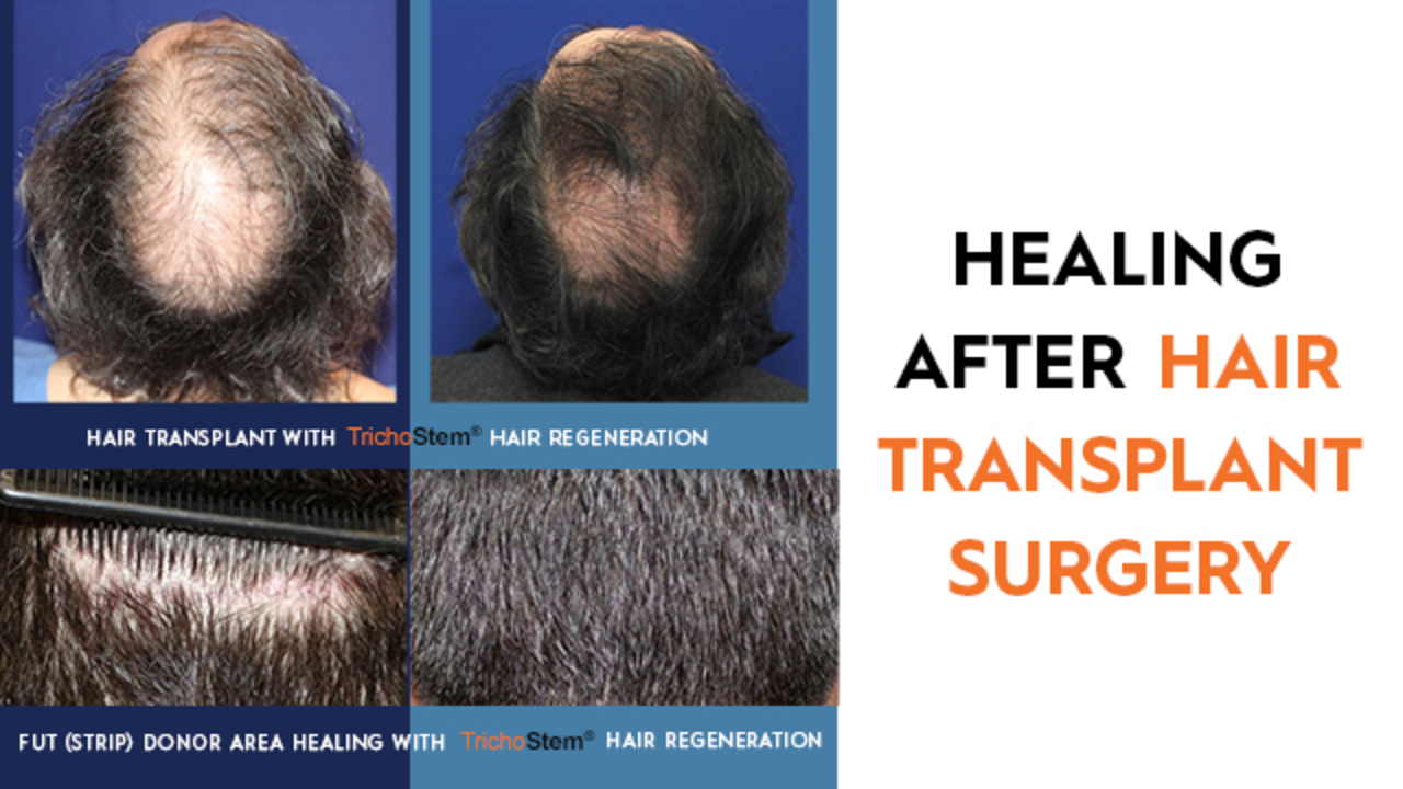 Healing After Hair Transplant Surgery; and Improving Recovery, and ...