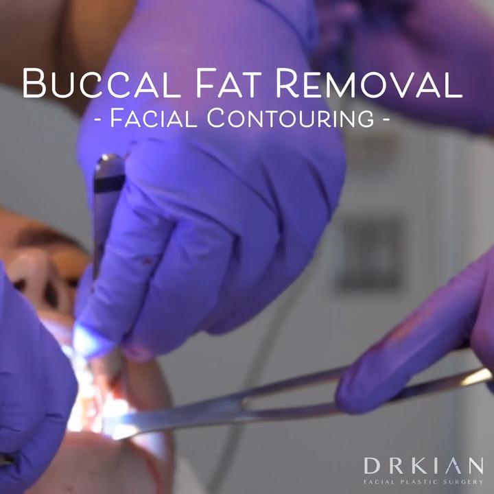 Buccal Fat Removal For Facial Contouring With Dr Kian Karimi Graphic