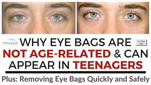 learn-how-genetic-eye-bags-can-be-removed-video-realself