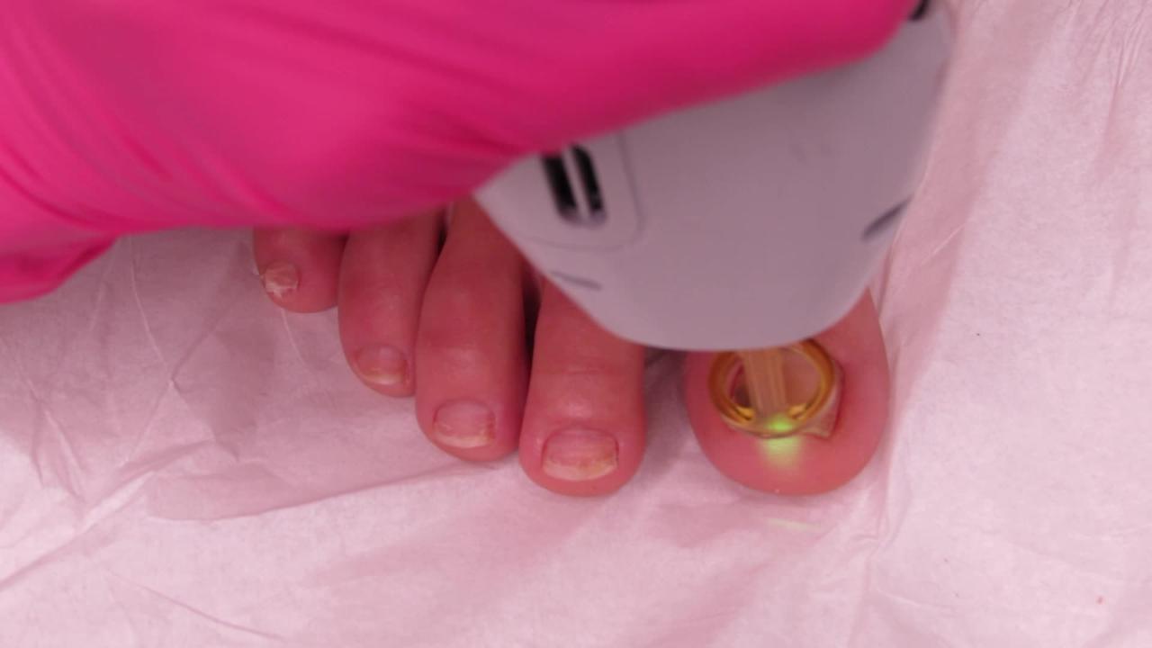 Laser Toenail Fungus Removal Treatment - Video - RealSelf