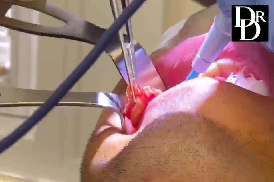 Buccal Fat Pad Removal Graphic Video Realself