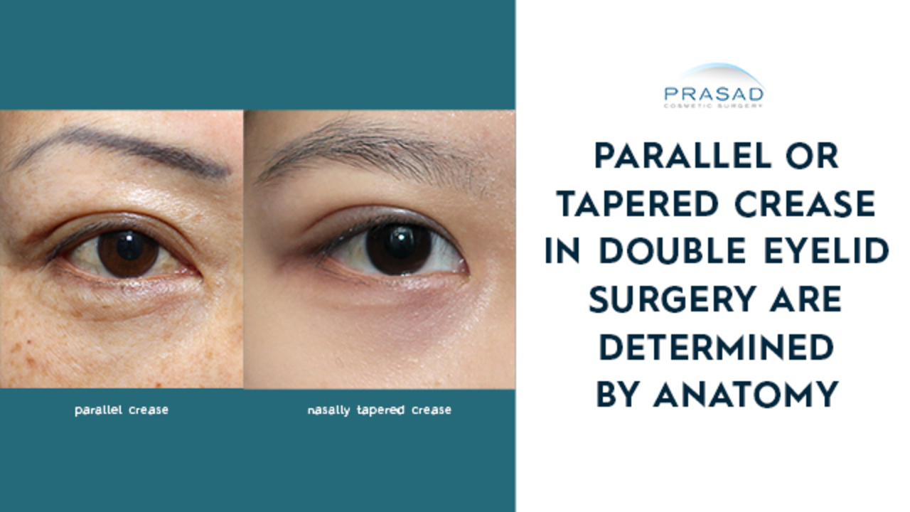 How A Parallel Or Tapered Eyelid Crease Is Determined In Asian Double