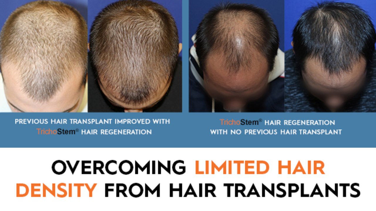 Why Hair Density is the Most Common Complaint with Hair Transplants ...