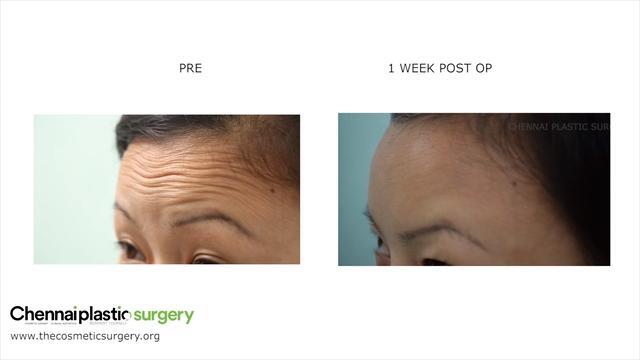 Pre And Post Botox For Ageing Signs Video RealSelf   Image 