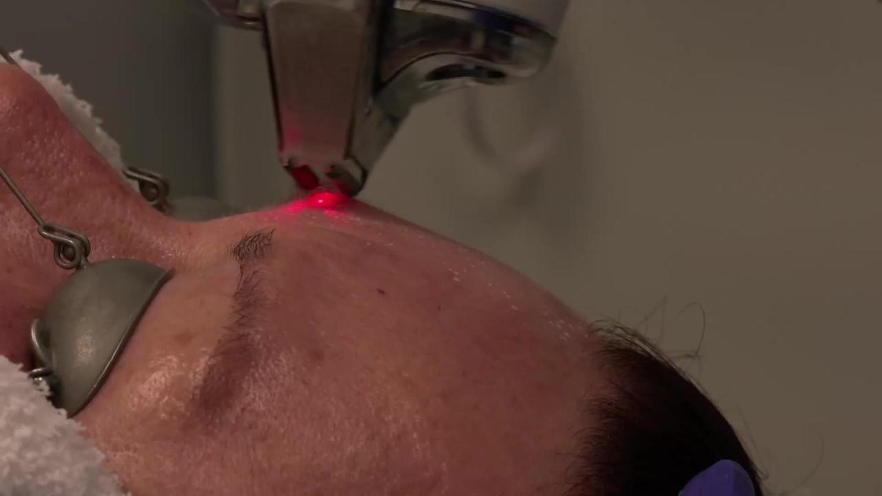 What Is The Halo Laser Skin Treatment For Aging And Uv Damaged Skin